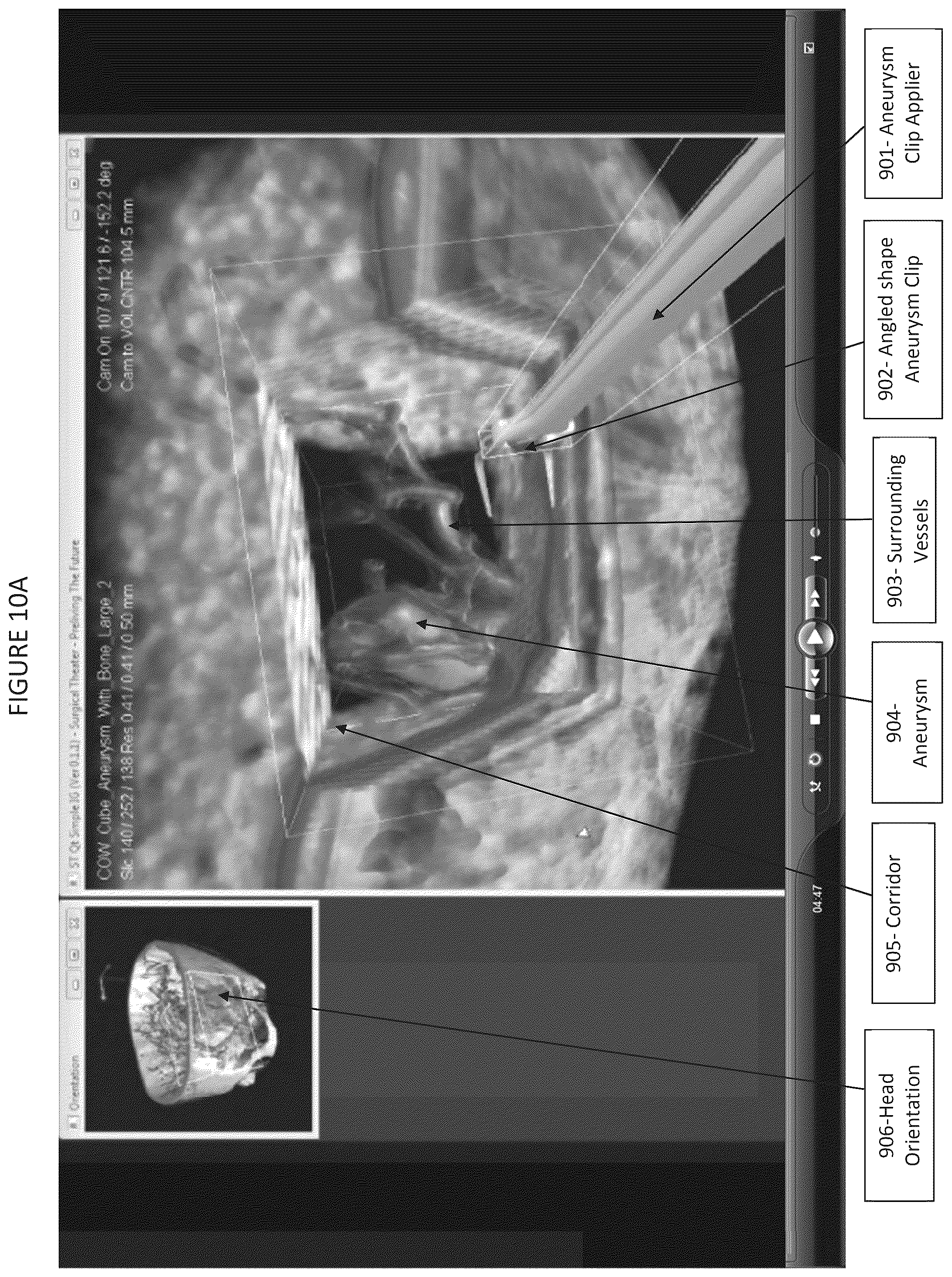 Patent US12508077 Figure 12 – Method and system for simulating surgical procedures