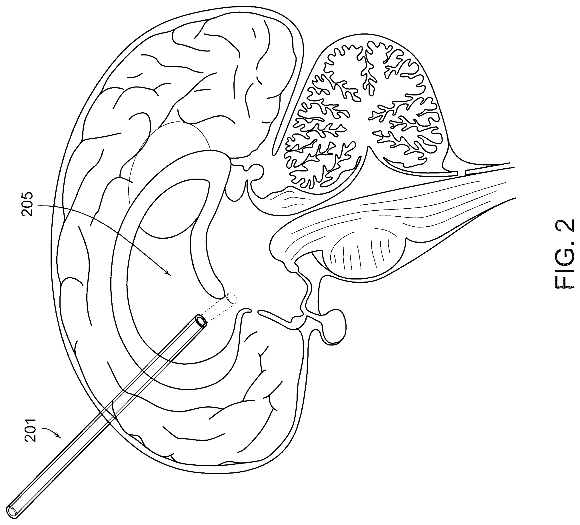 Patent US12508079 Figure 2 – Systems and methods for high-bandwidth minimally invasive brain-computer interfaces