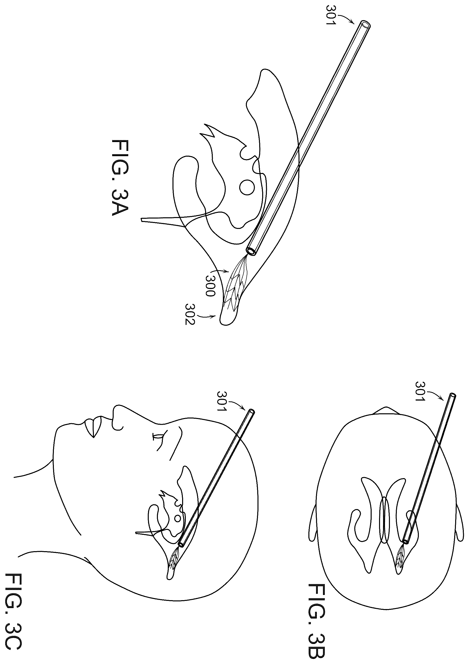 Patent US12508079 Figure 3 – Systems and methods for high-bandwidth minimally invasive brain-computer interfaces