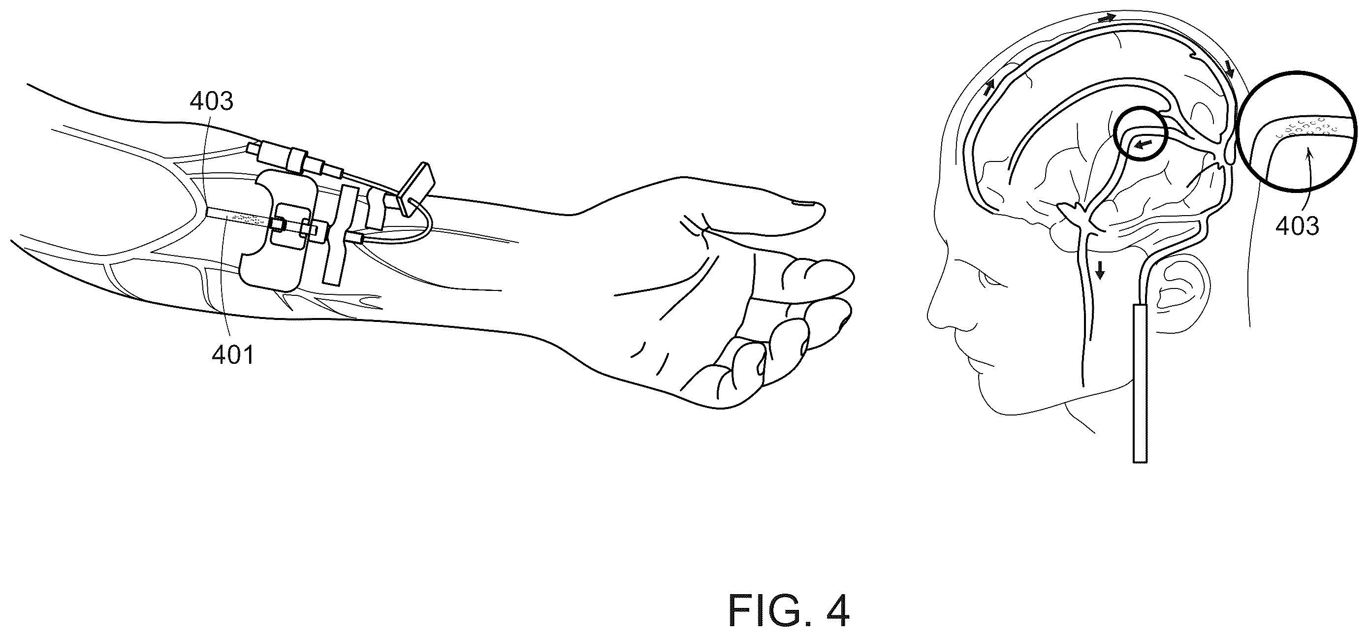 Patent US12508079 Figure 4 – Systems and methods for high-bandwidth minimally invasive brain-computer interfaces