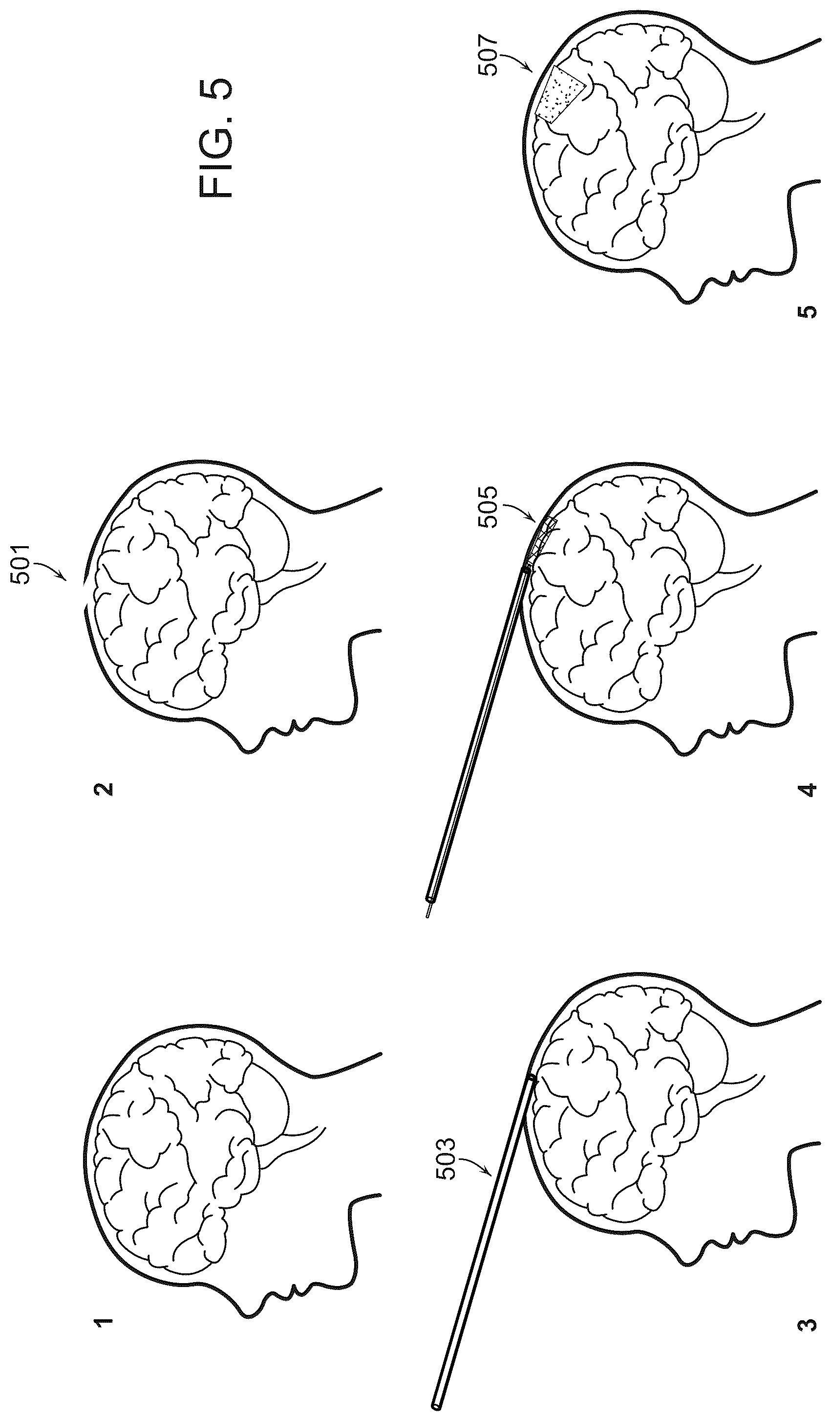 Patent US12508079 Figure 5 – Systems and methods for high-bandwidth minimally invasive brain-computer interfaces