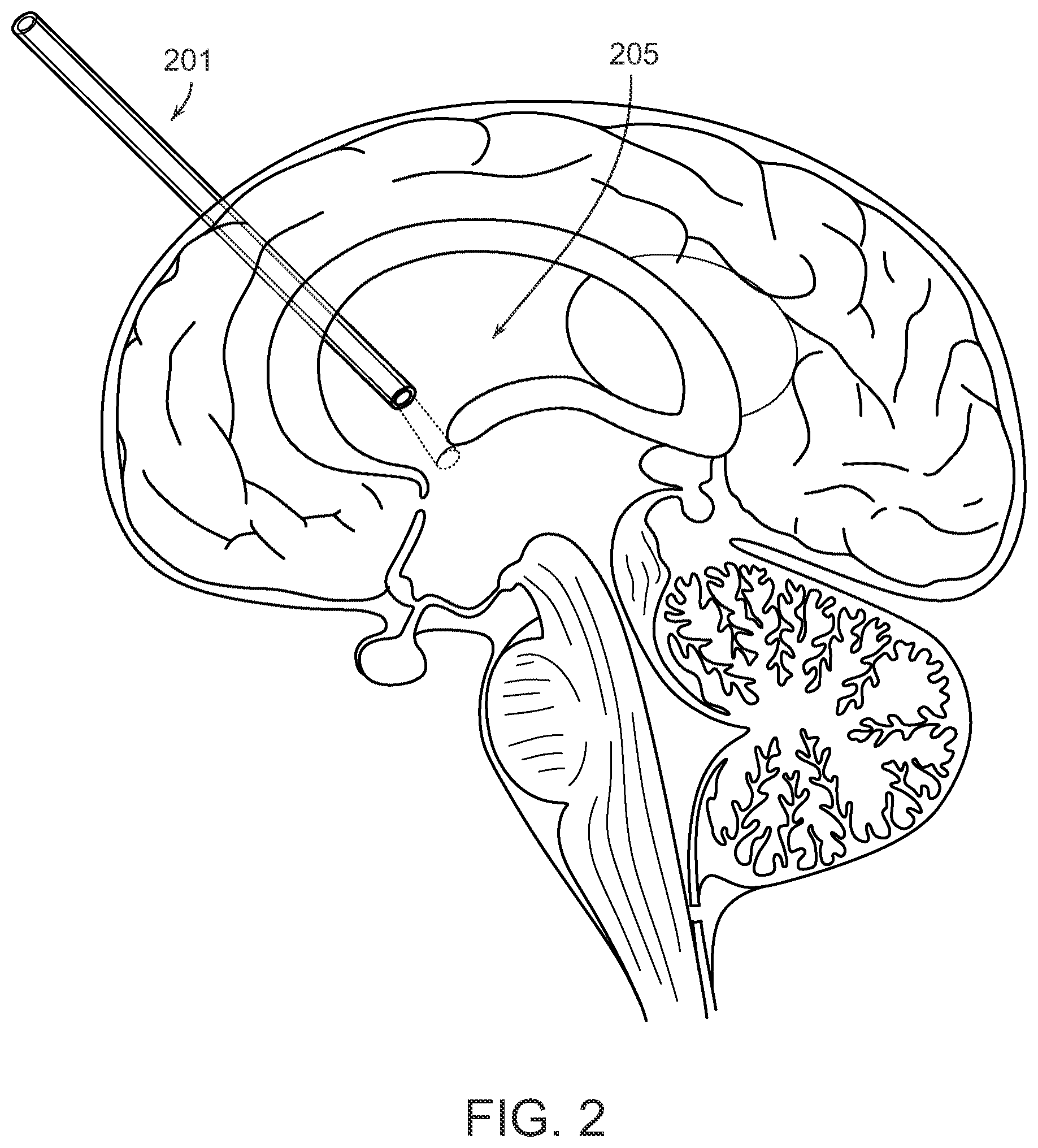 Patent US12508084 Figure 2 – Systems and methods for high-bandwidth minimally invasive brain-computer interfaces