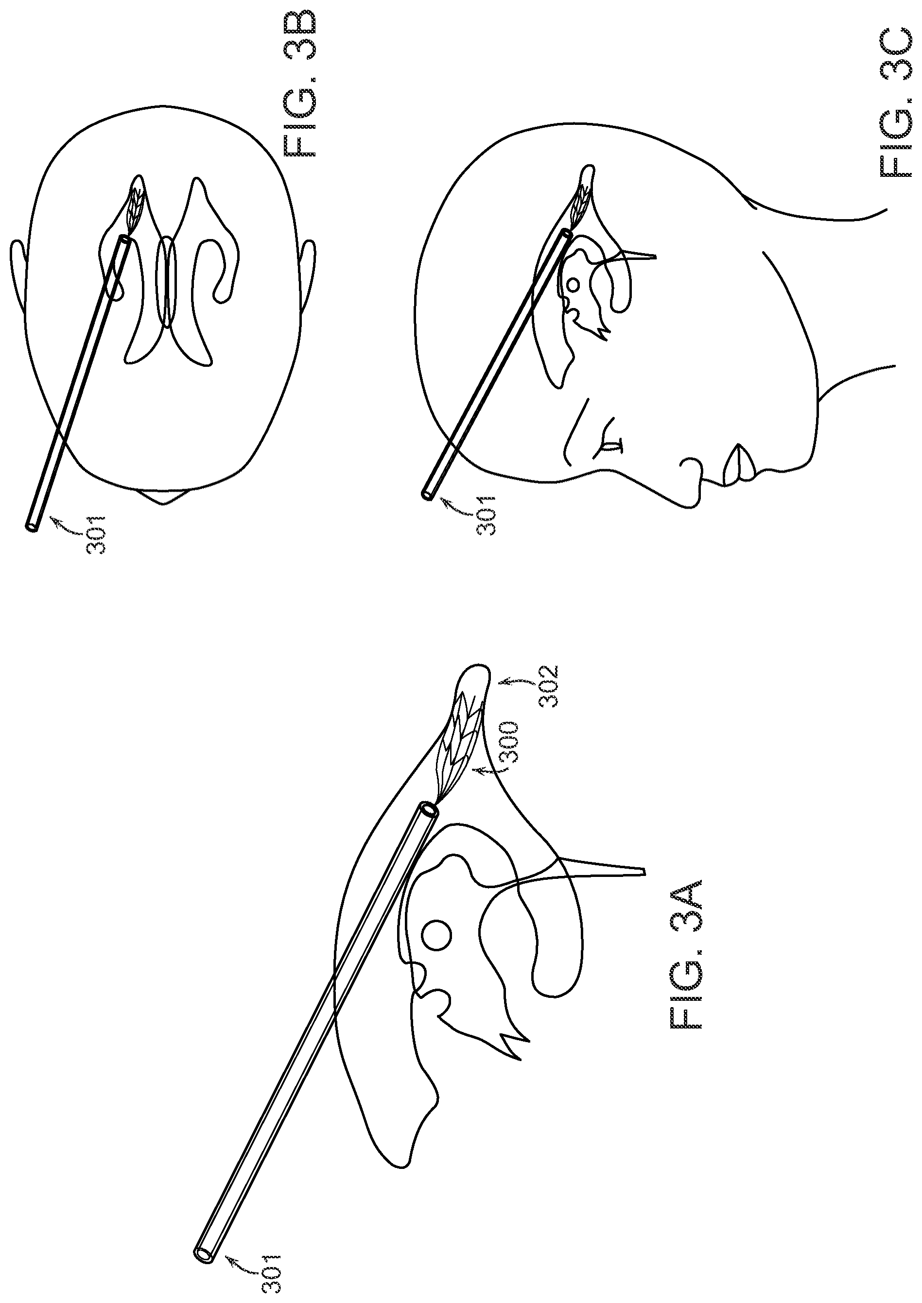 Patent US12508084 Figure 3 – Systems and methods for high-bandwidth minimally invasive brain-computer interfaces