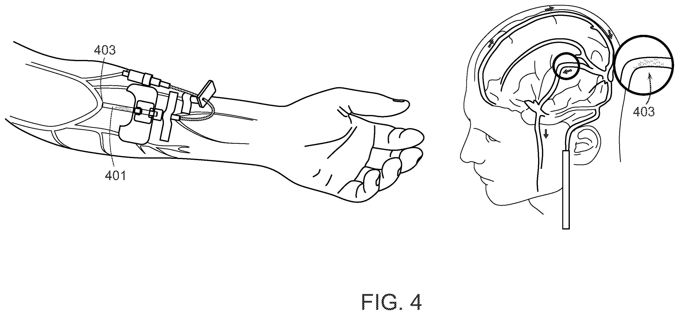 Patent US12508084 Figure 4 – Systems and methods for high-bandwidth minimally invasive brain-computer interfaces