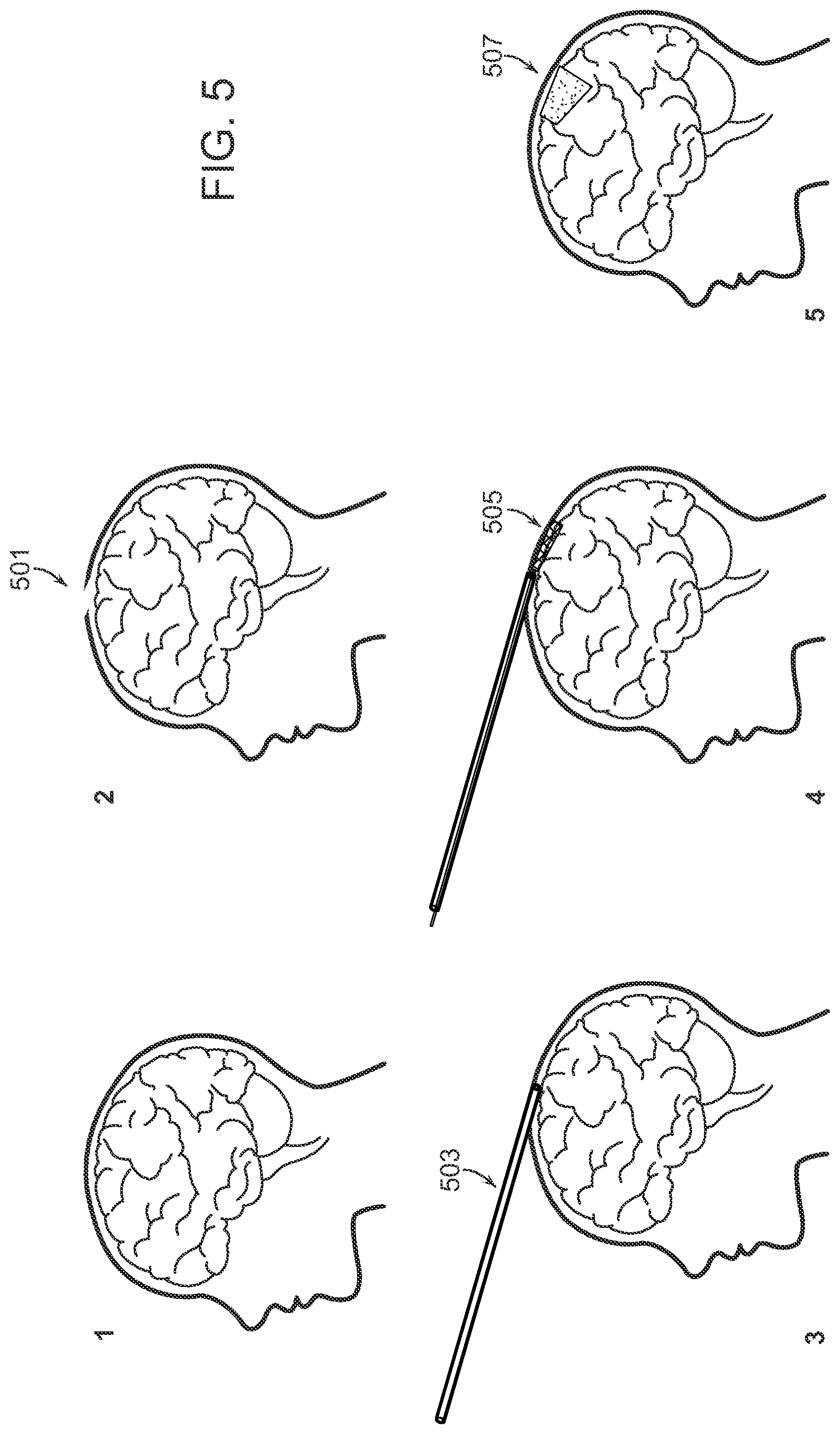 Patent US12508084 Figure 5 – Systems and methods for high-bandwidth minimally invasive brain-computer interfaces