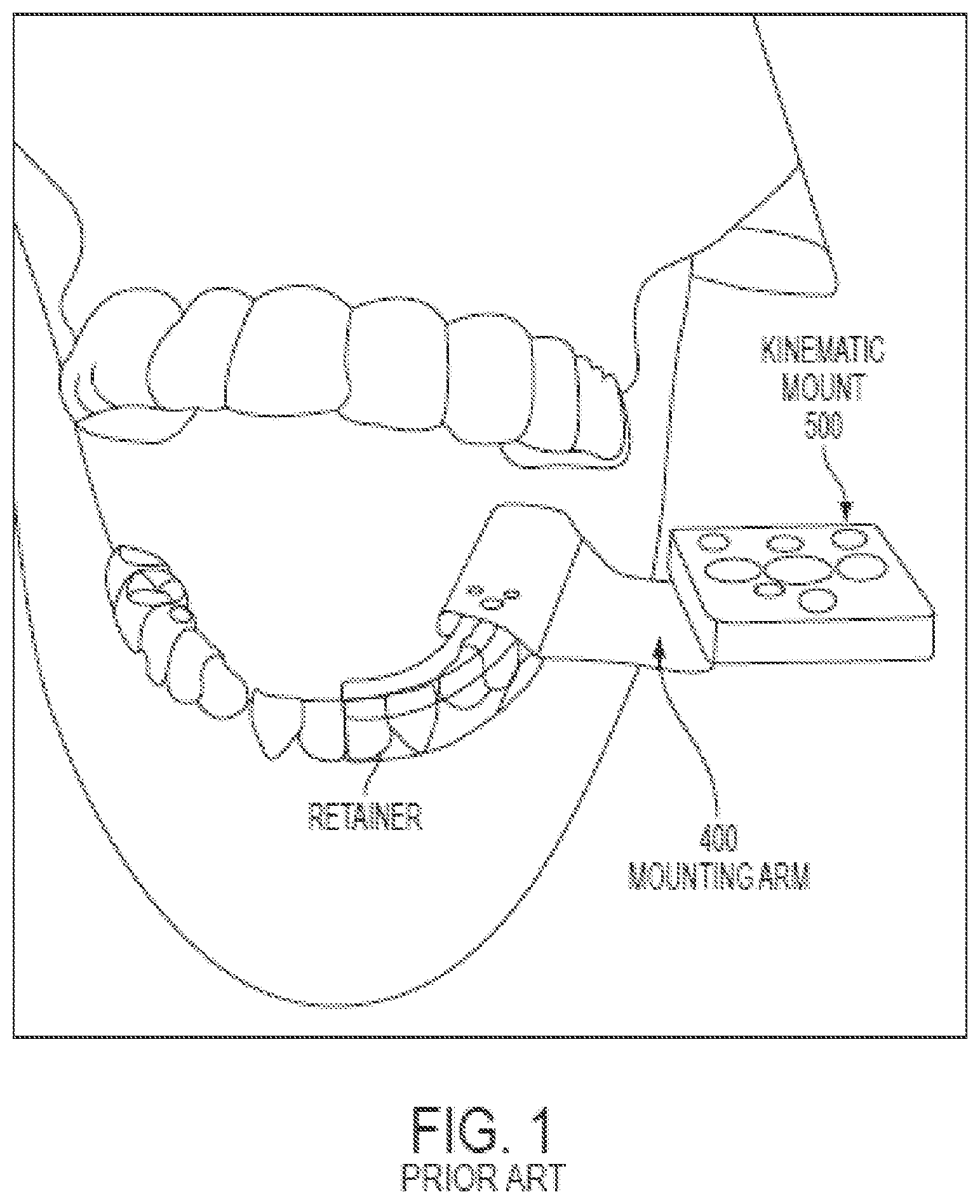 Patent US12508087 Figure 1 – Splint device for guided surgical robot