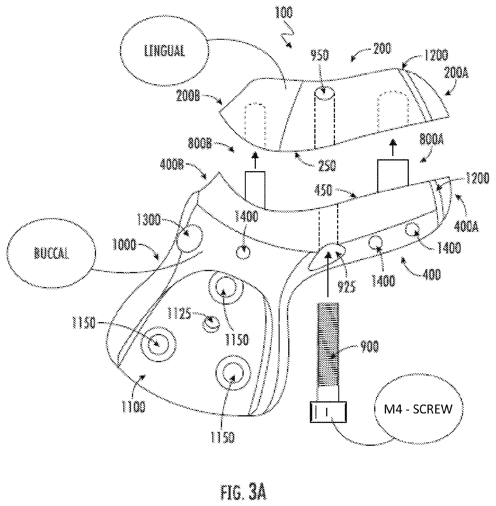 Patent US12508087 Figure 3 – Splint device for guided surgical robot