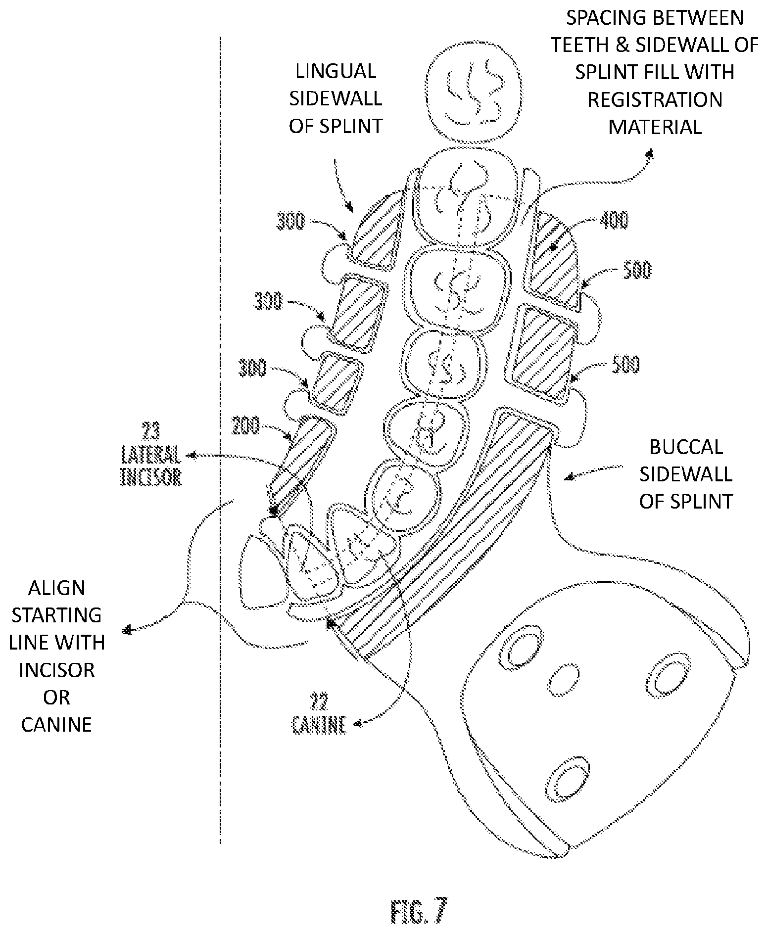 Patent US12508087 Figure 6 – Splint device for guided surgical robot