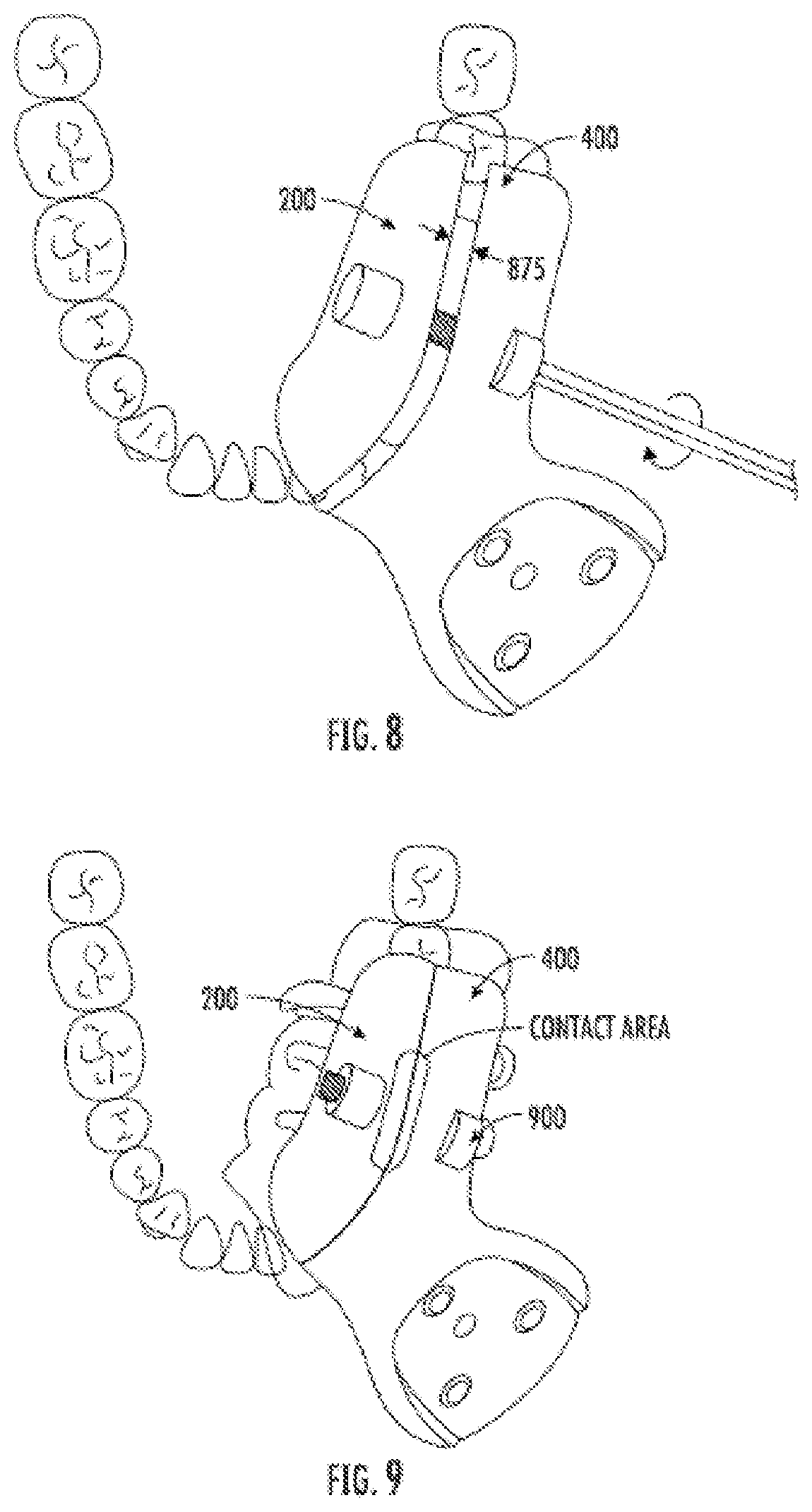 Patent US12508087 Figure 7 – Splint device for guided surgical robot