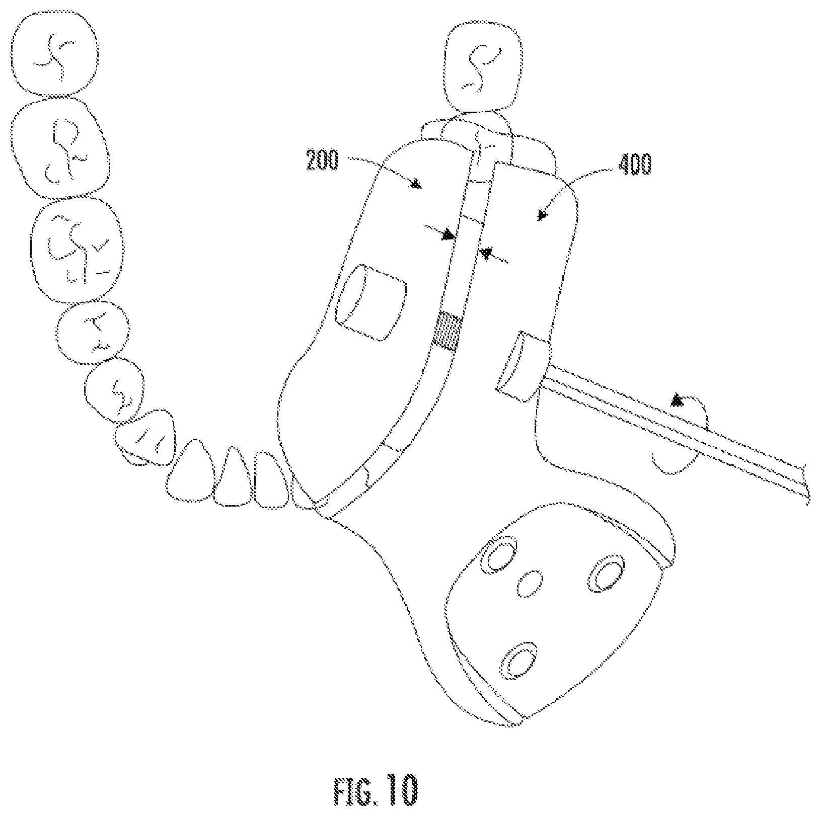 Patent US12508087 Figure 8 – Splint device for guided surgical robot