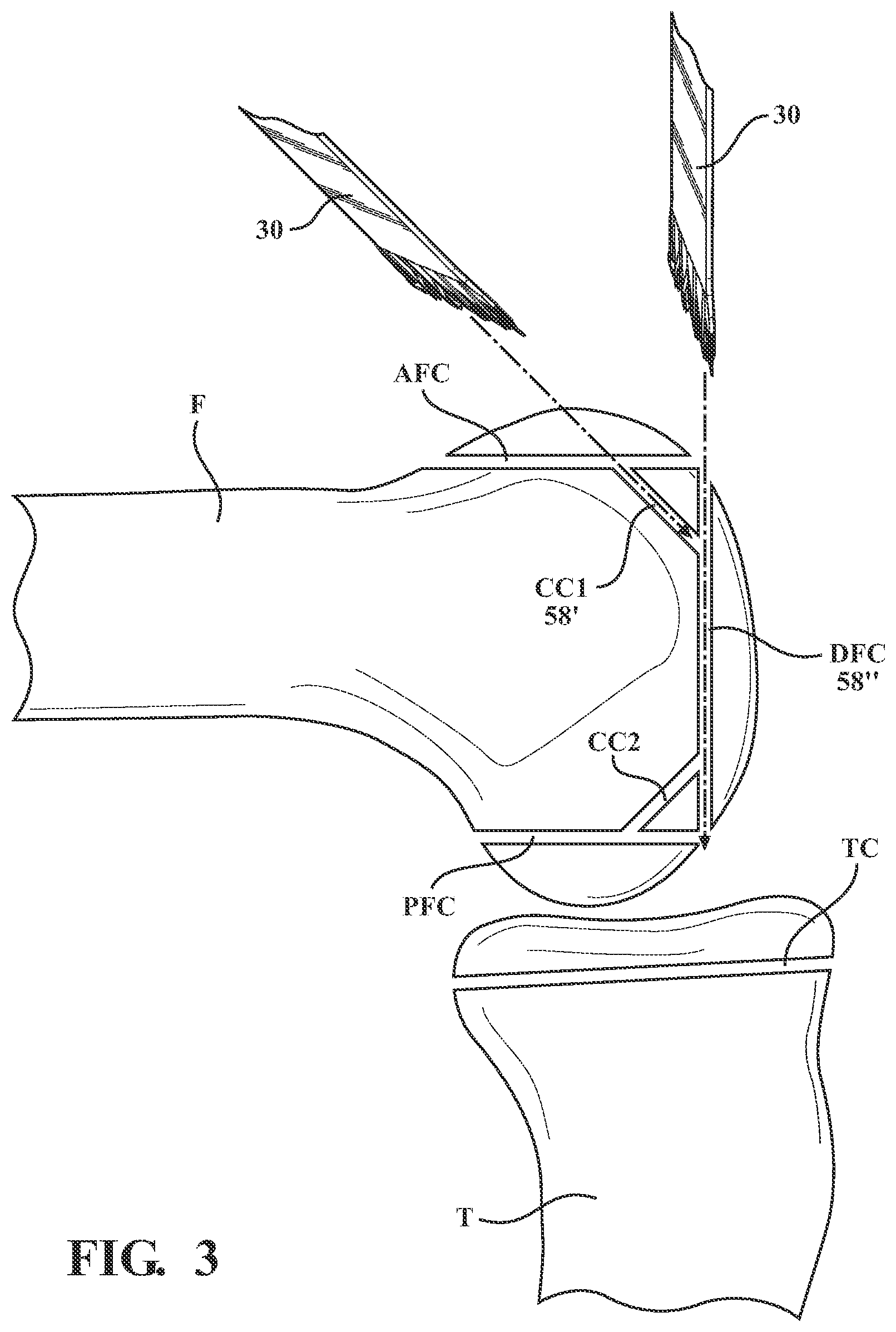 Patent US12508088 Figure 3 – Selectively automated robotic surgical system
