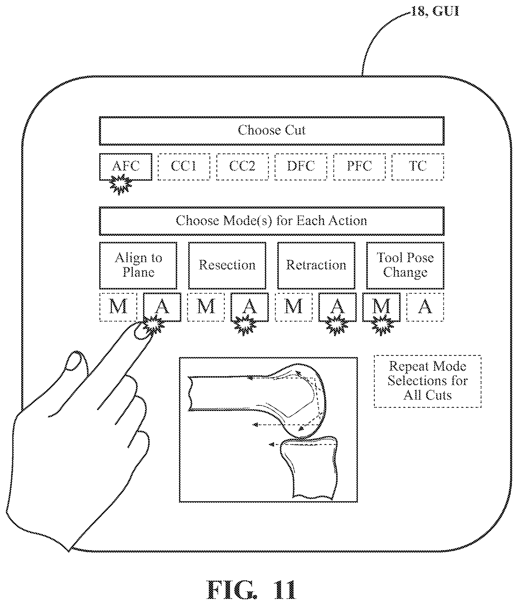 Patent US12508088 Figure 11 – Selectively automated robotic surgical system