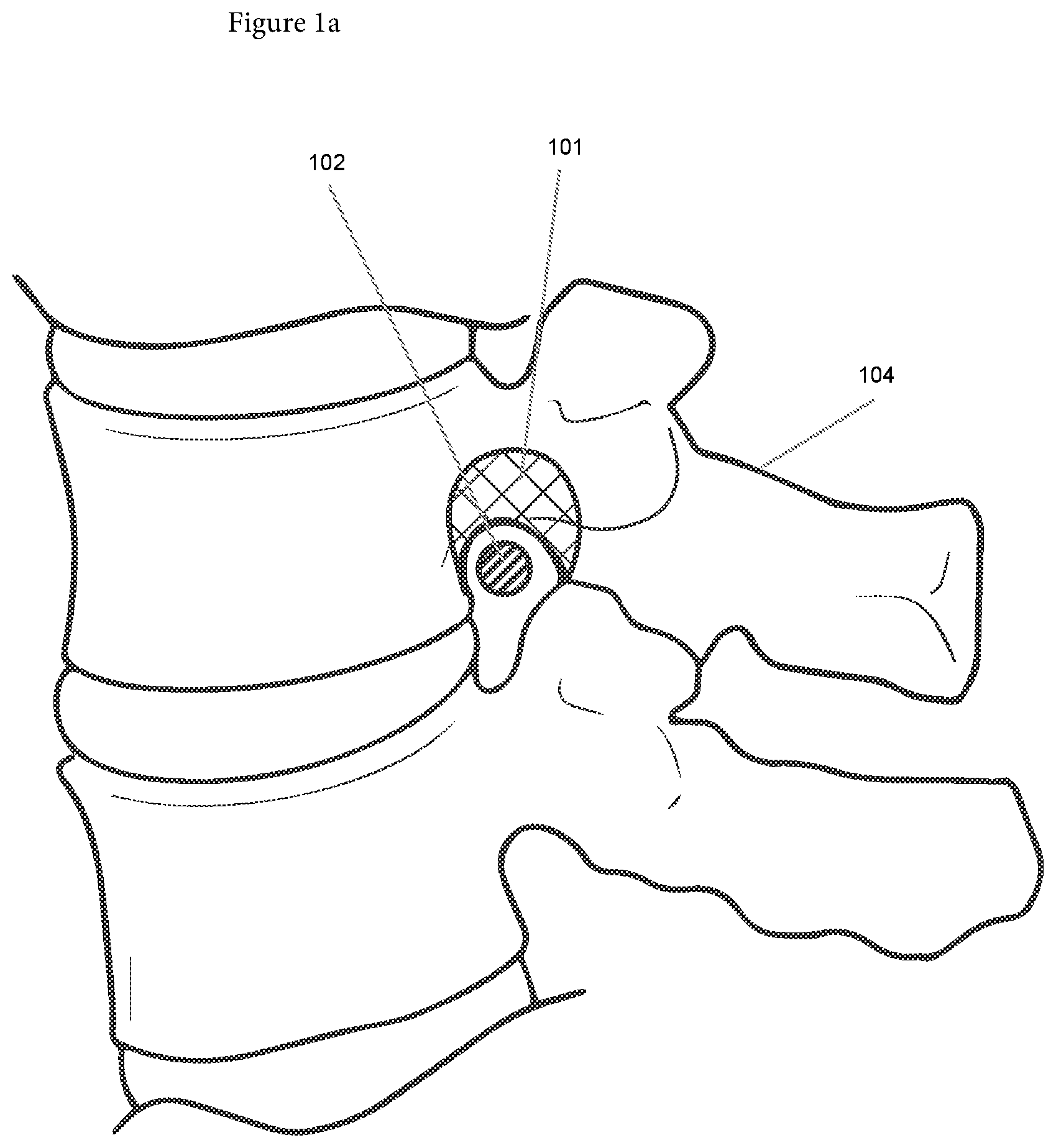 Patent US12508090 Figure 1 – Synchronized robotic bone milling