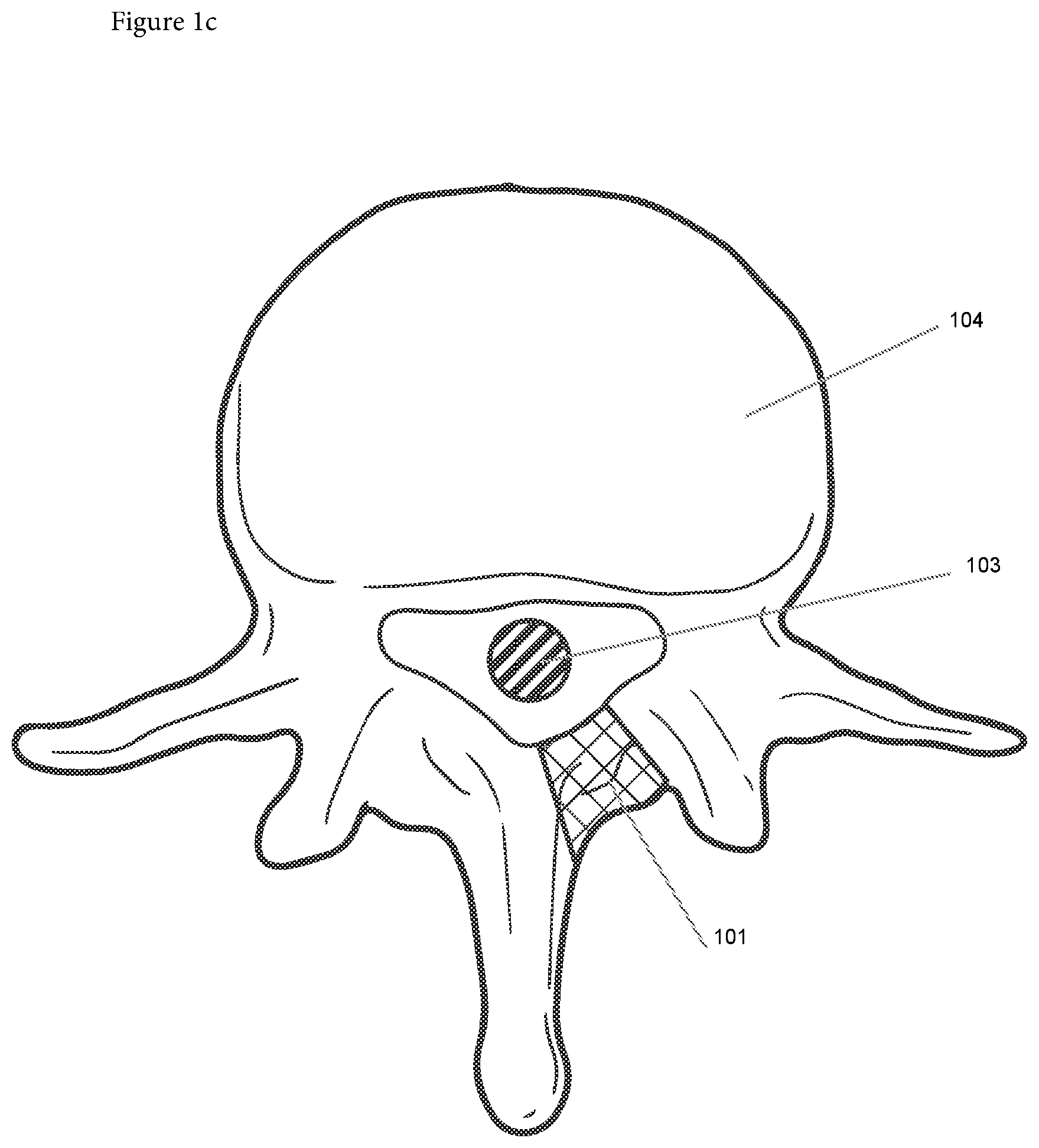 Patent US12508090 Figure 3 – Synchronized robotic bone milling