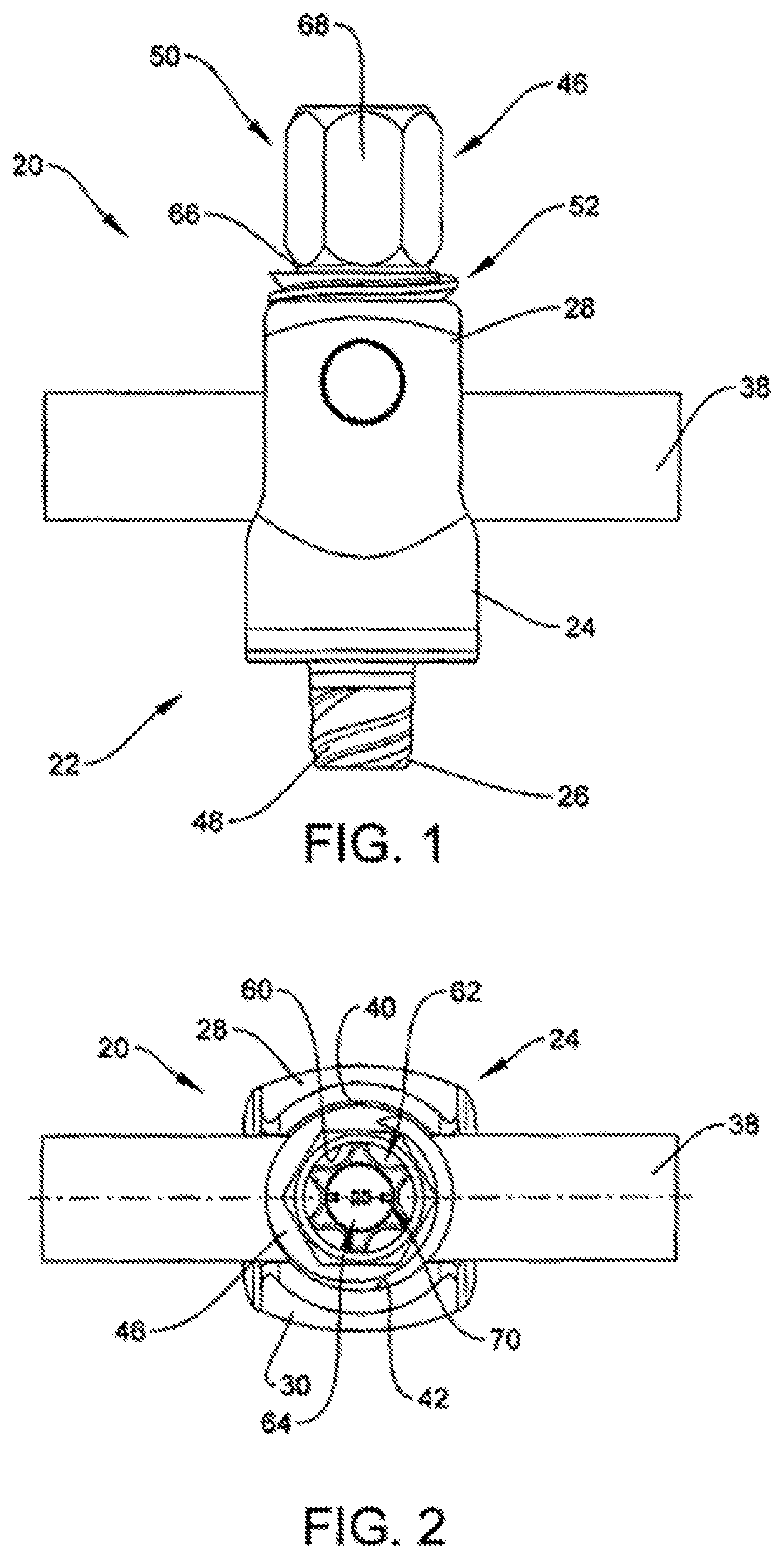 Patent US12508097 Figure 1 – Set screw with strain gauges
