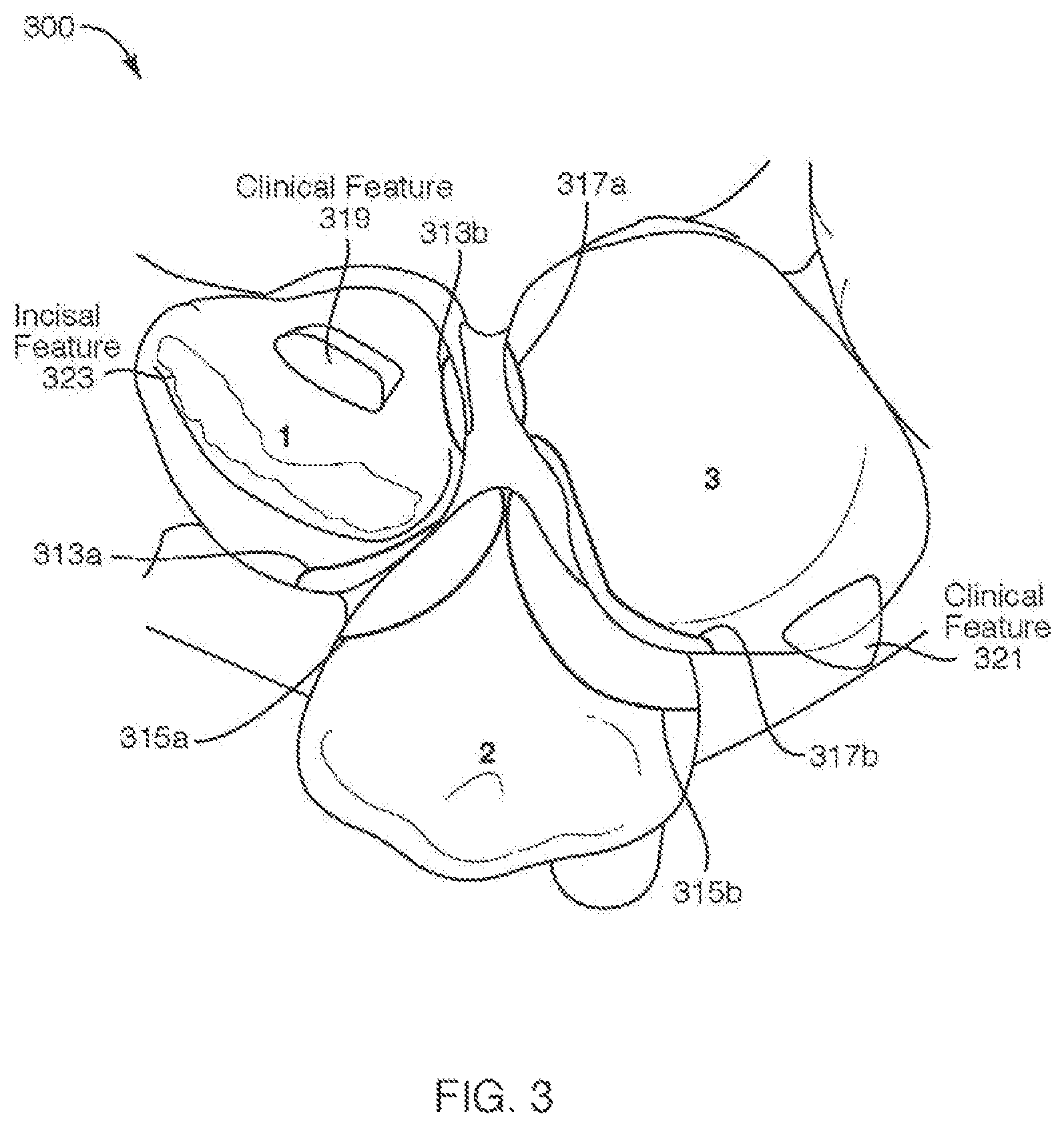 Patent US12508102 Figure 3 – Mold Fabrication using virtual fillers
