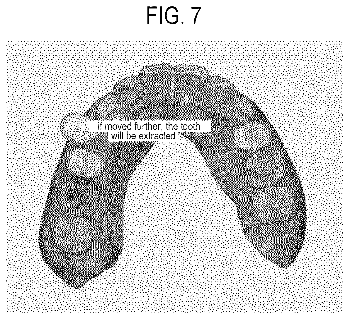 Patent US12508103 Figure 7 – System for displaying orthodontic information of oral cavity