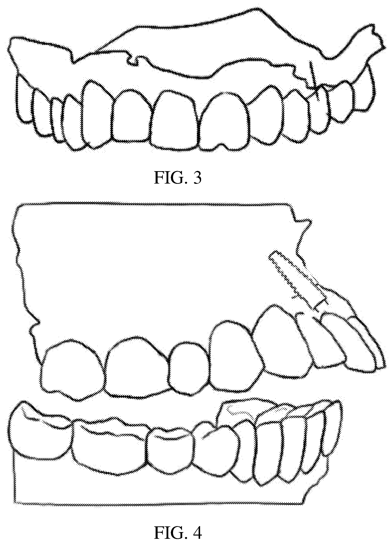 Patent US12508108 Figure 2 – Axial direction and depth checking guide plate for implanting and manufacture method thereof