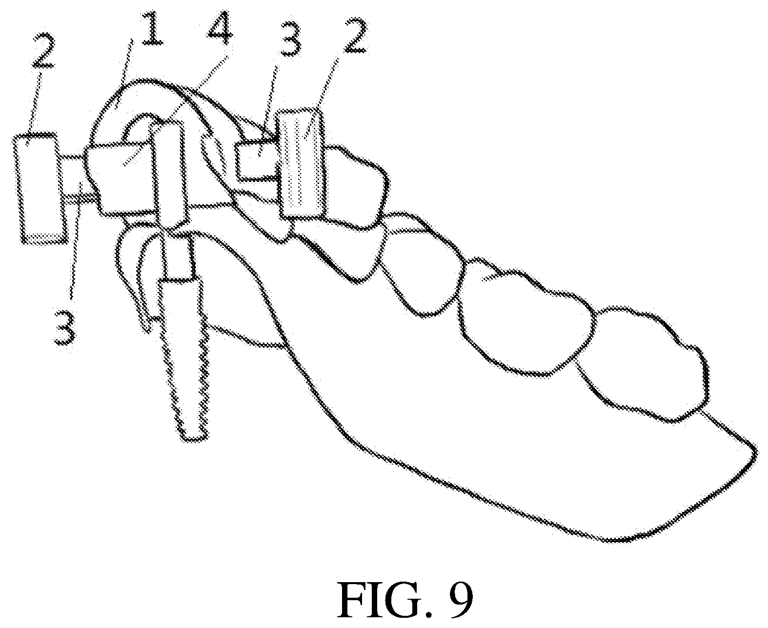 Patent US12508108 Figure 5 – Axial direction and depth checking guide plate for implanting and manufacture method thereof