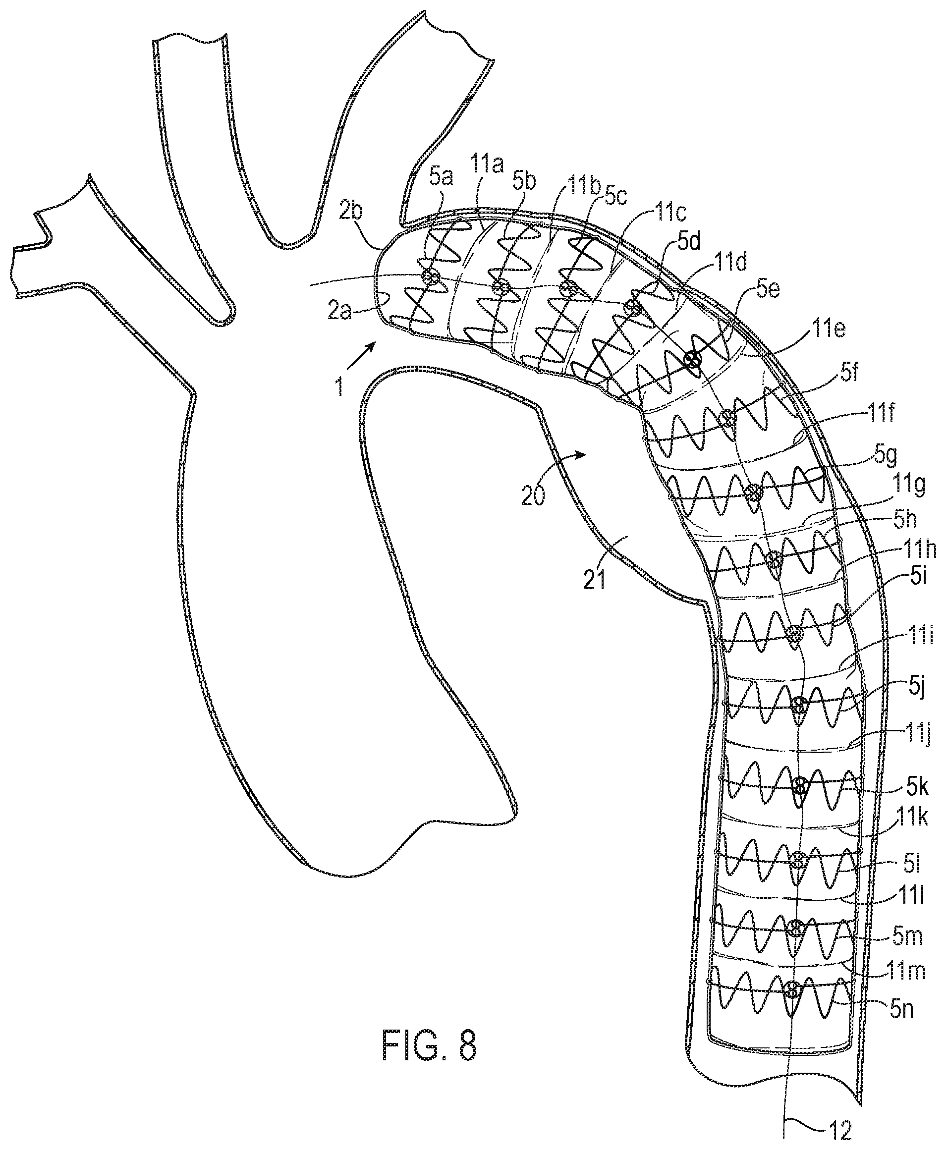 Patent US12508118 Figure 8 – Stent graft systems with restraints in channels and methods thereof