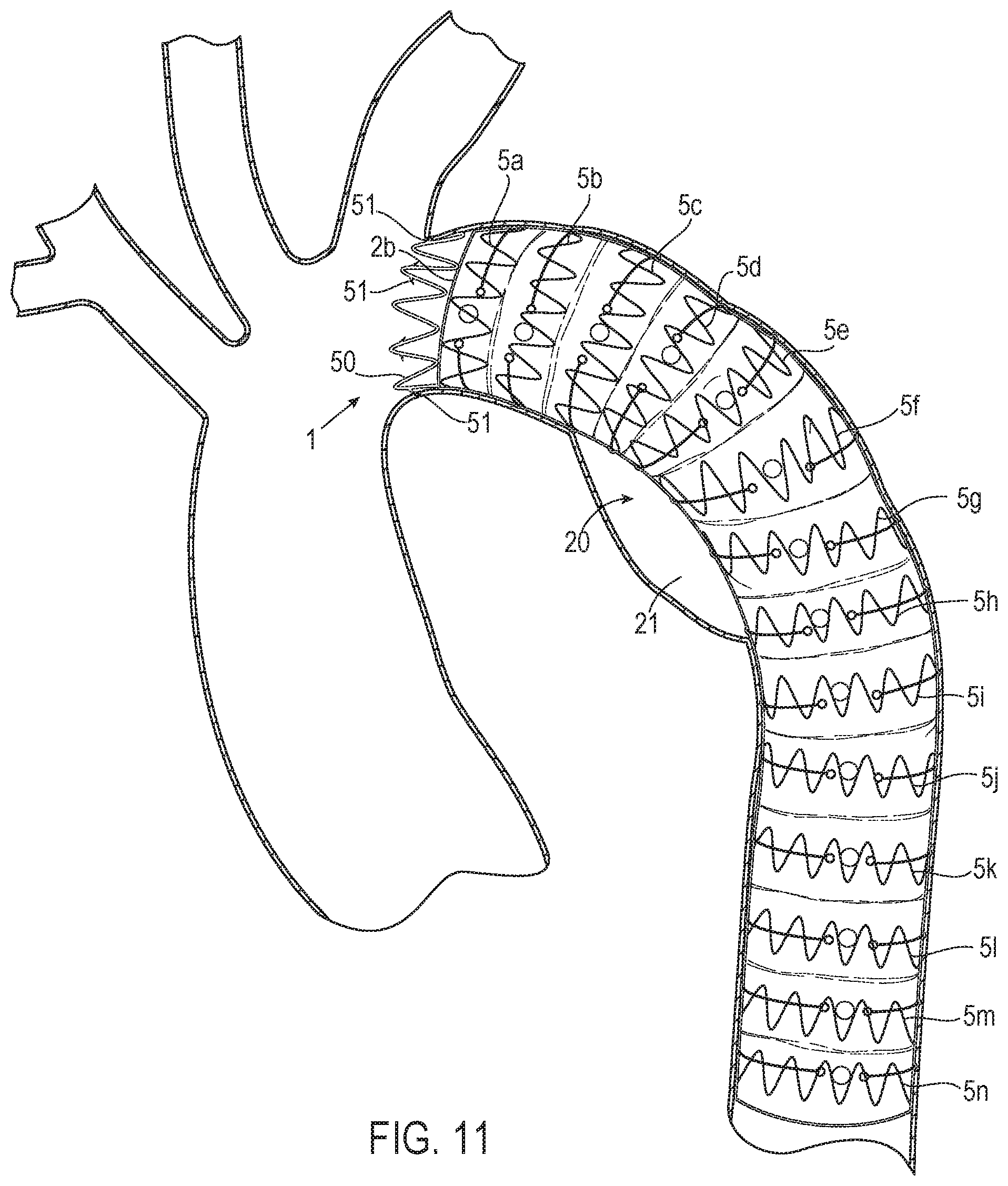 Patent US12508118 Figure 11 – Stent graft systems with restraints in channels and methods thereof