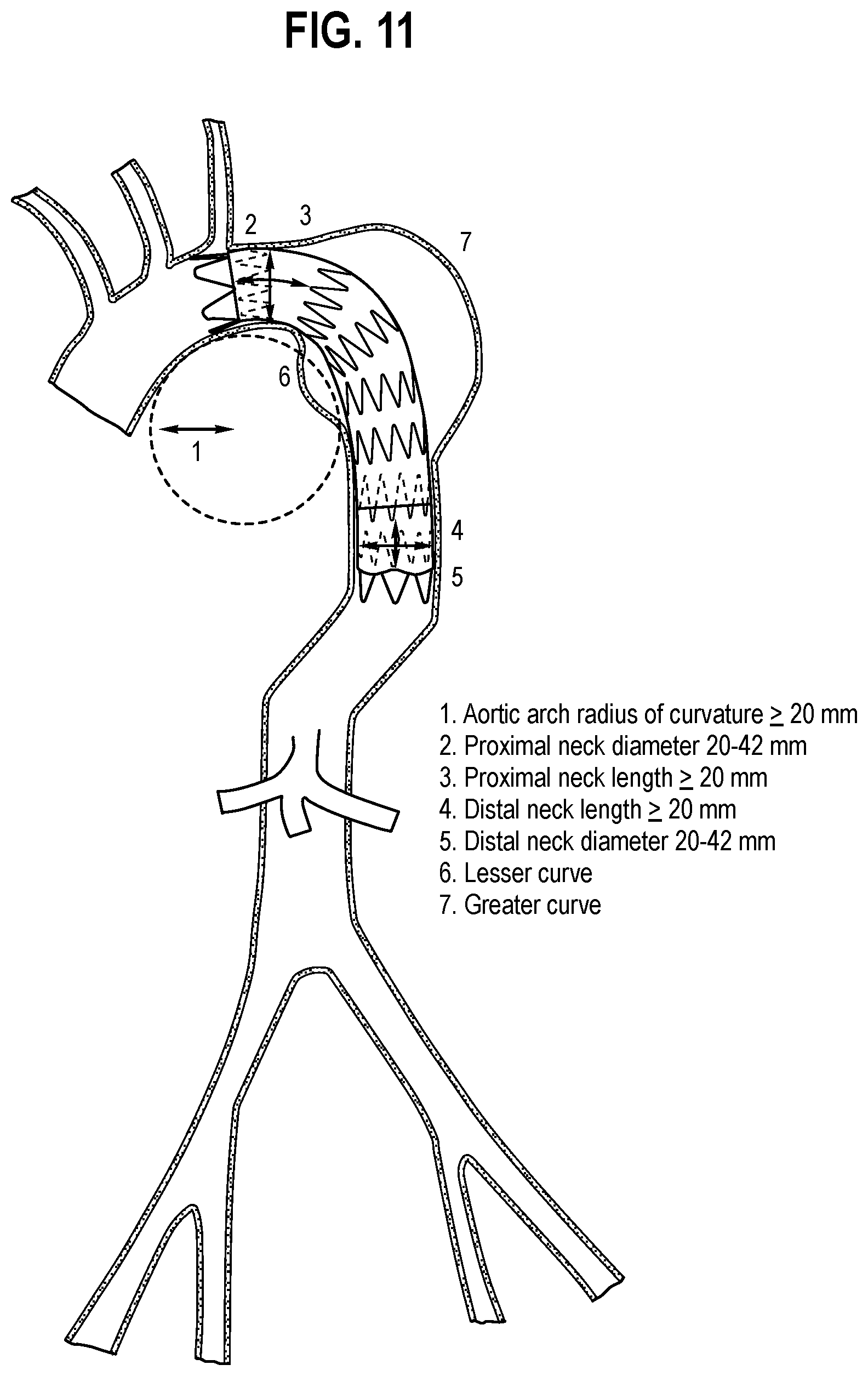 Patent US12508119 Figure 6 – Stent graft