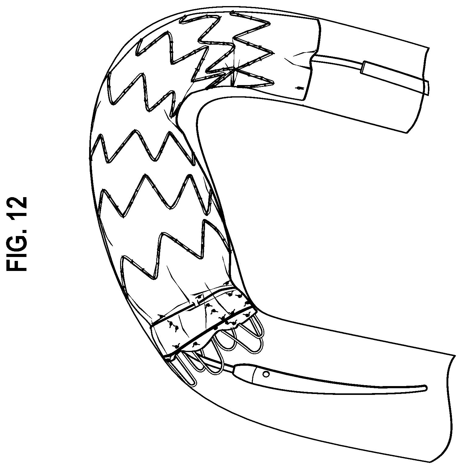 Patent US12508119 Figure 7 – Stent graft