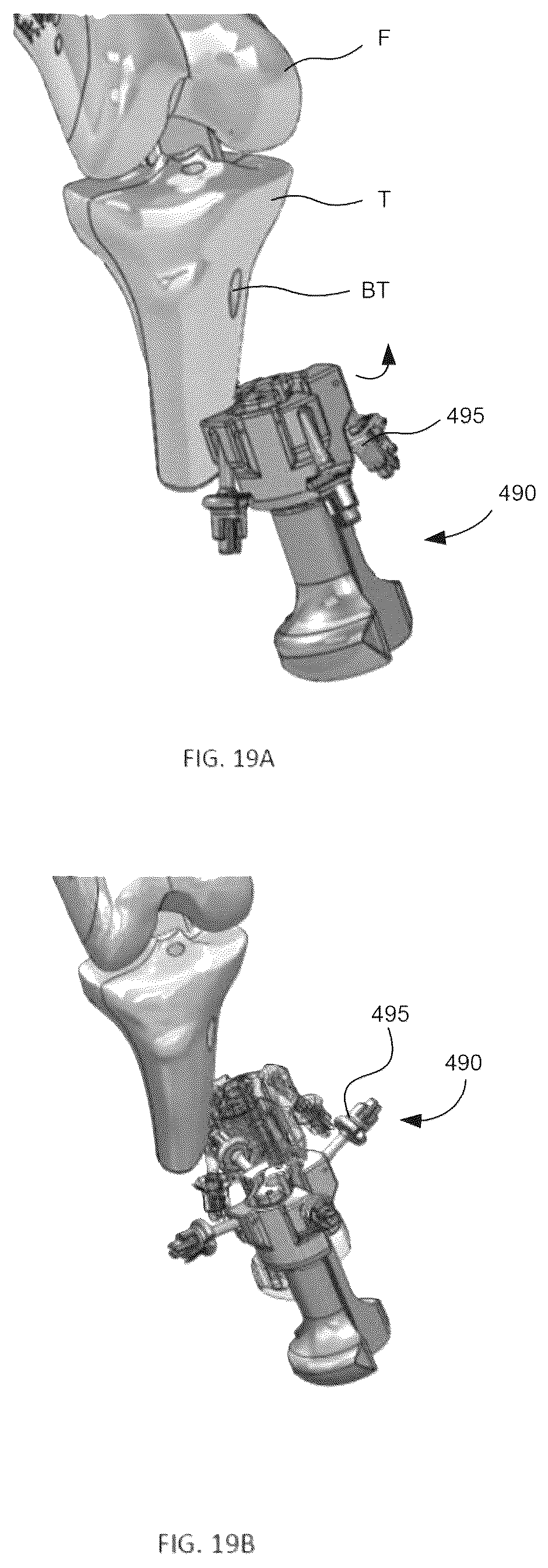 Patent US12508120 Figure 18 – Instrumentation for soft tissue reconstruction