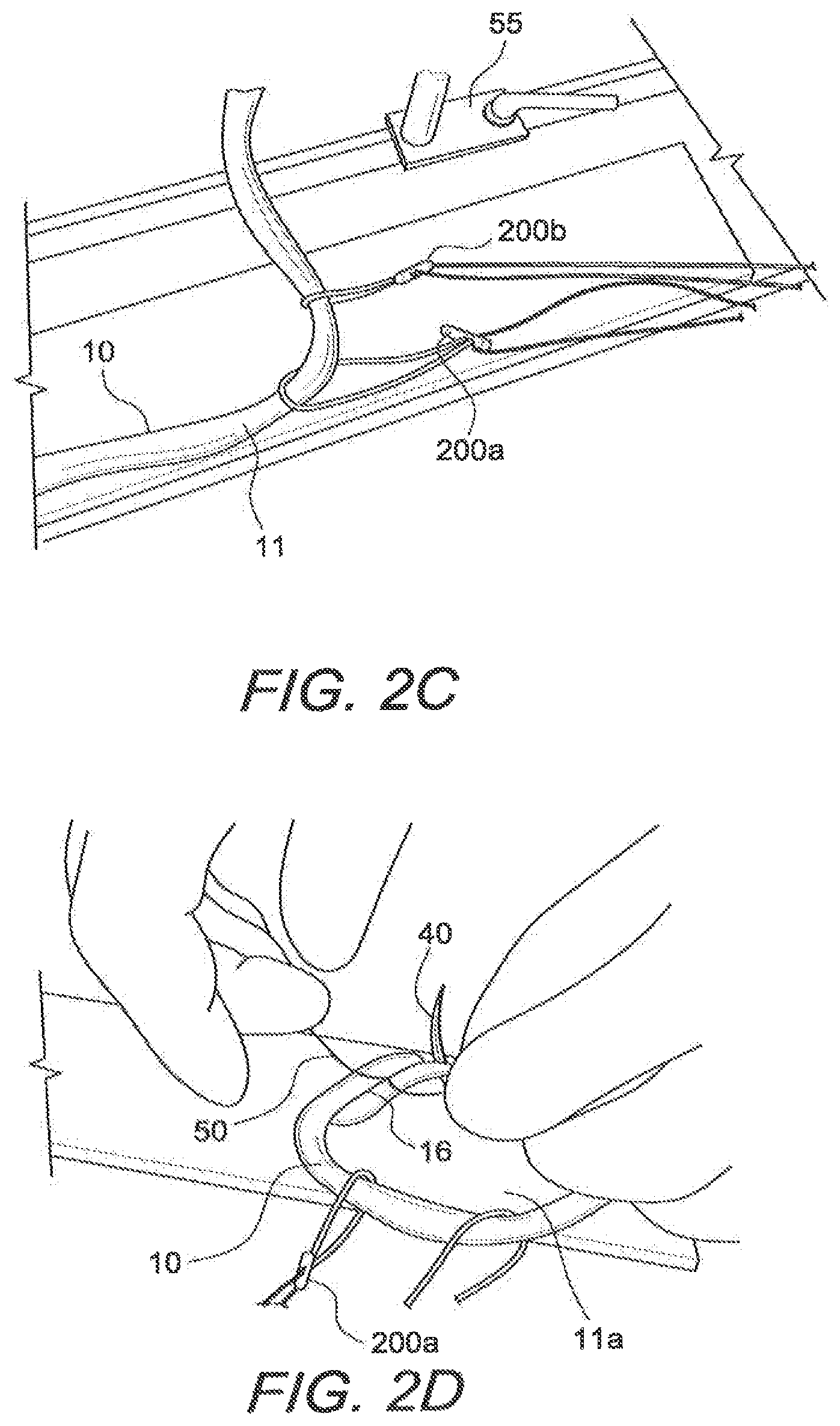Patent US12508121 Figure 3 – Reinforced biological construct and method of reinforcing biological construct