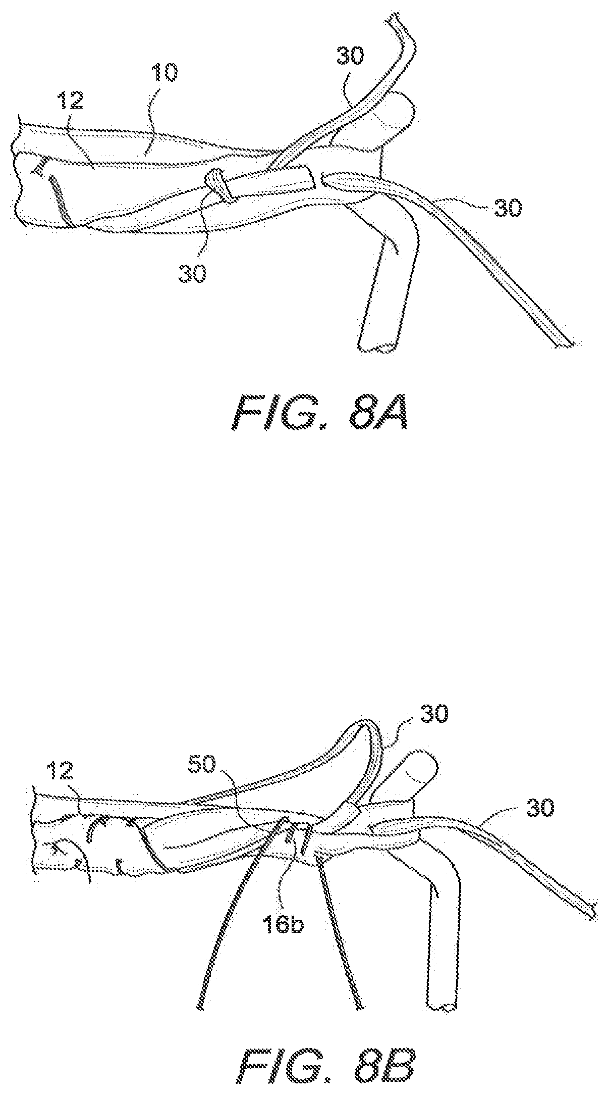 Patent US12508121 Figure 10 – Reinforced biological construct and method of reinforcing biological construct
