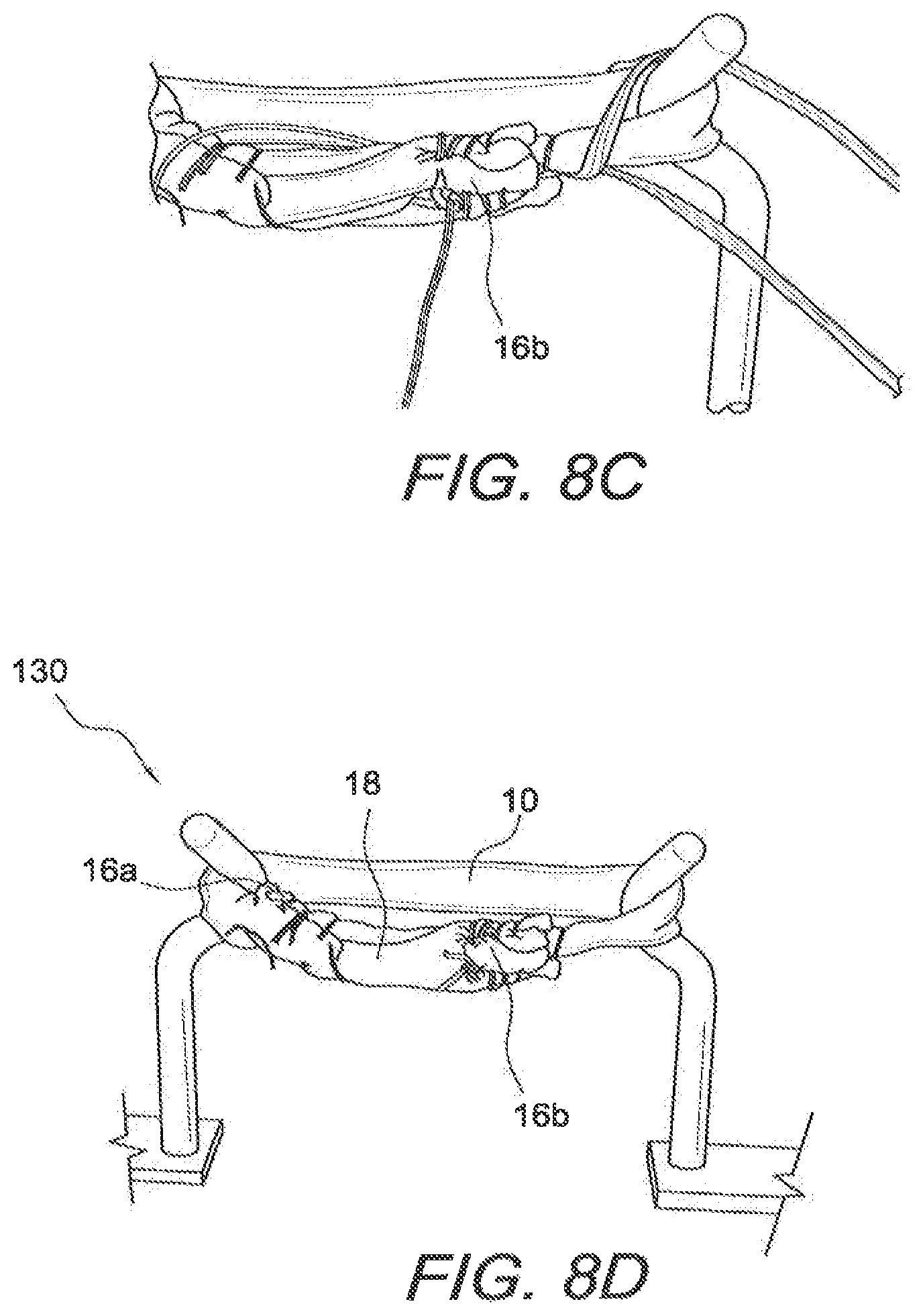 Patent US12508121 Figure 11 – Reinforced biological construct and method of reinforcing biological construct