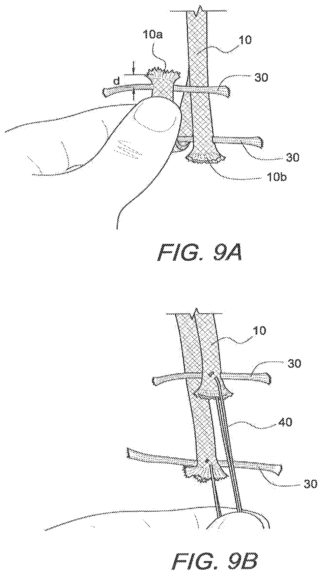 Patent US12508121 Figure 12 – Reinforced biological construct and method of reinforcing biological construct