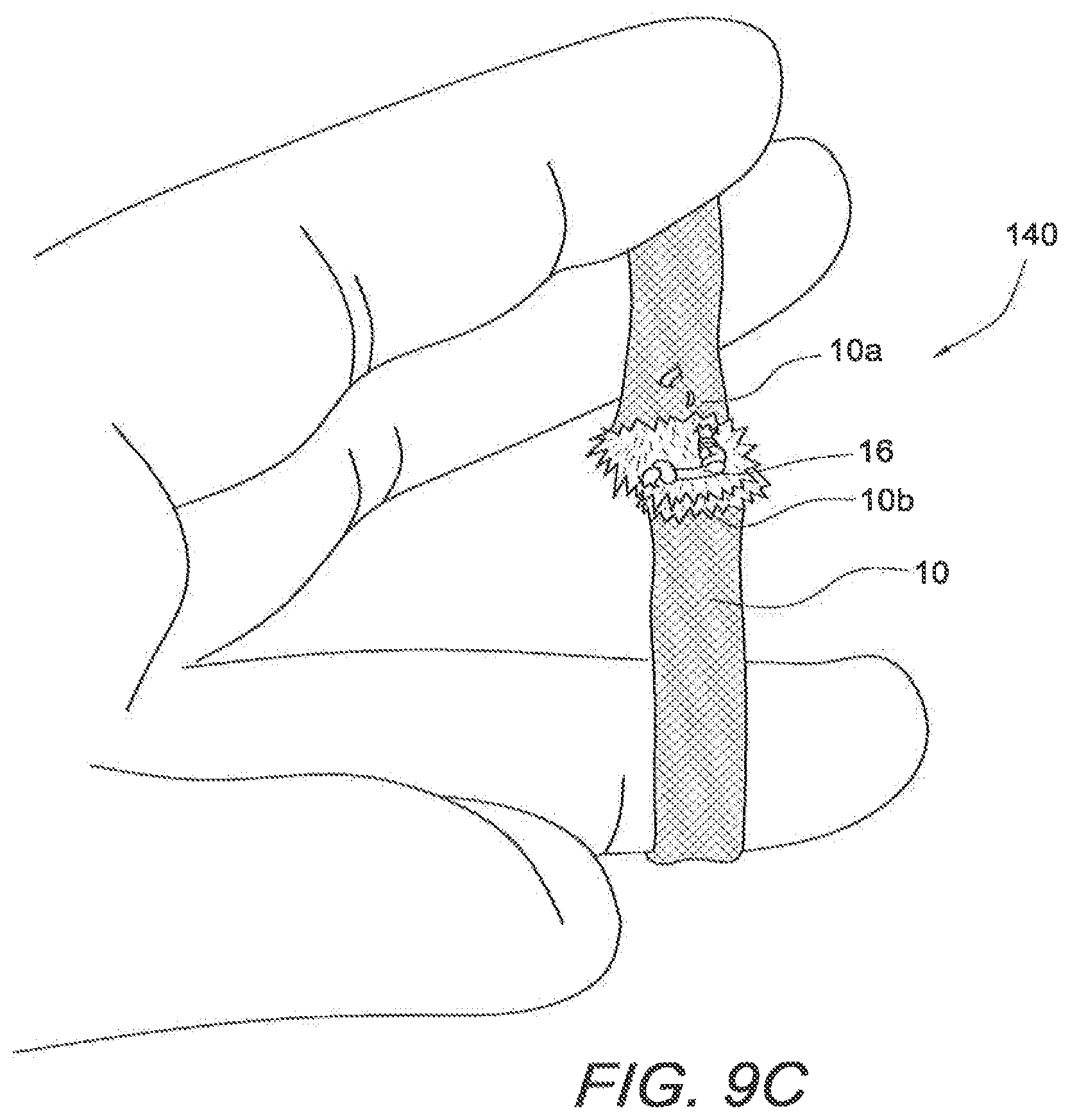 Patent US12508121 Figure 13 – Reinforced biological construct and method of reinforcing biological construct