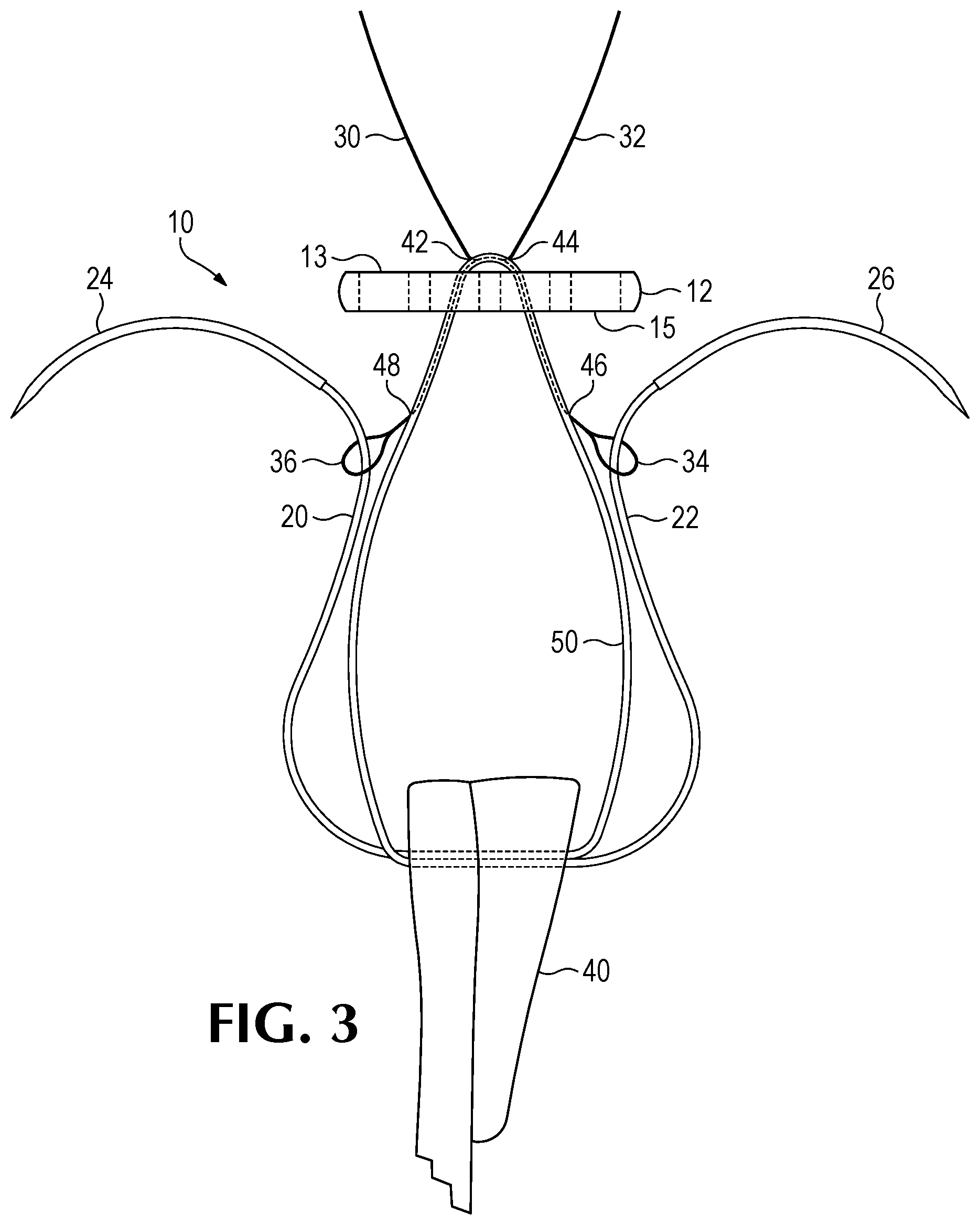 Patent US12508122 Figure 3 – Method of forming a suture-button-graft combination and facilitating construct