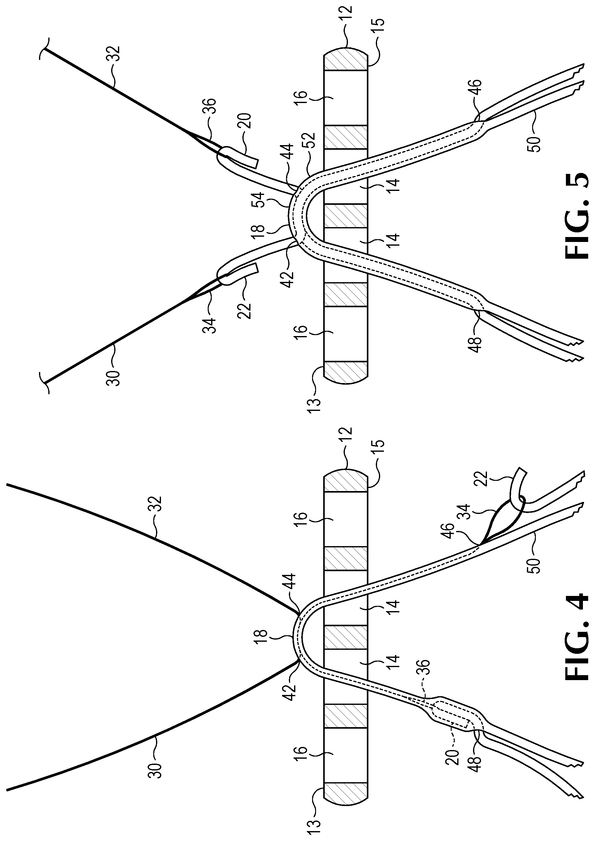 Patent US12508122 Figure 4 – Method of forming a suture-button-graft combination and facilitating construct