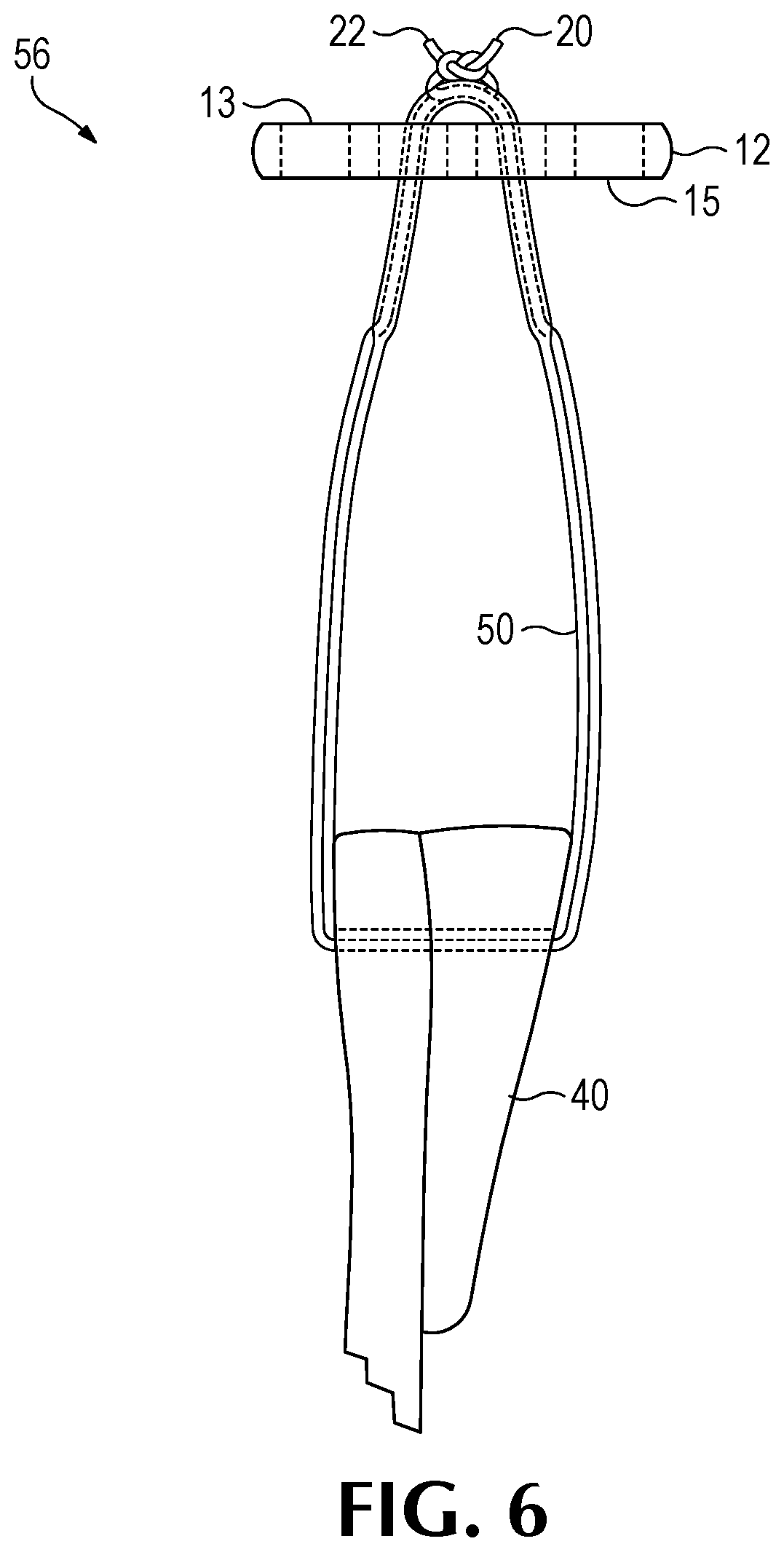 Patent US12508122 Figure 5 – Method of forming a suture-button-graft combination and facilitating construct