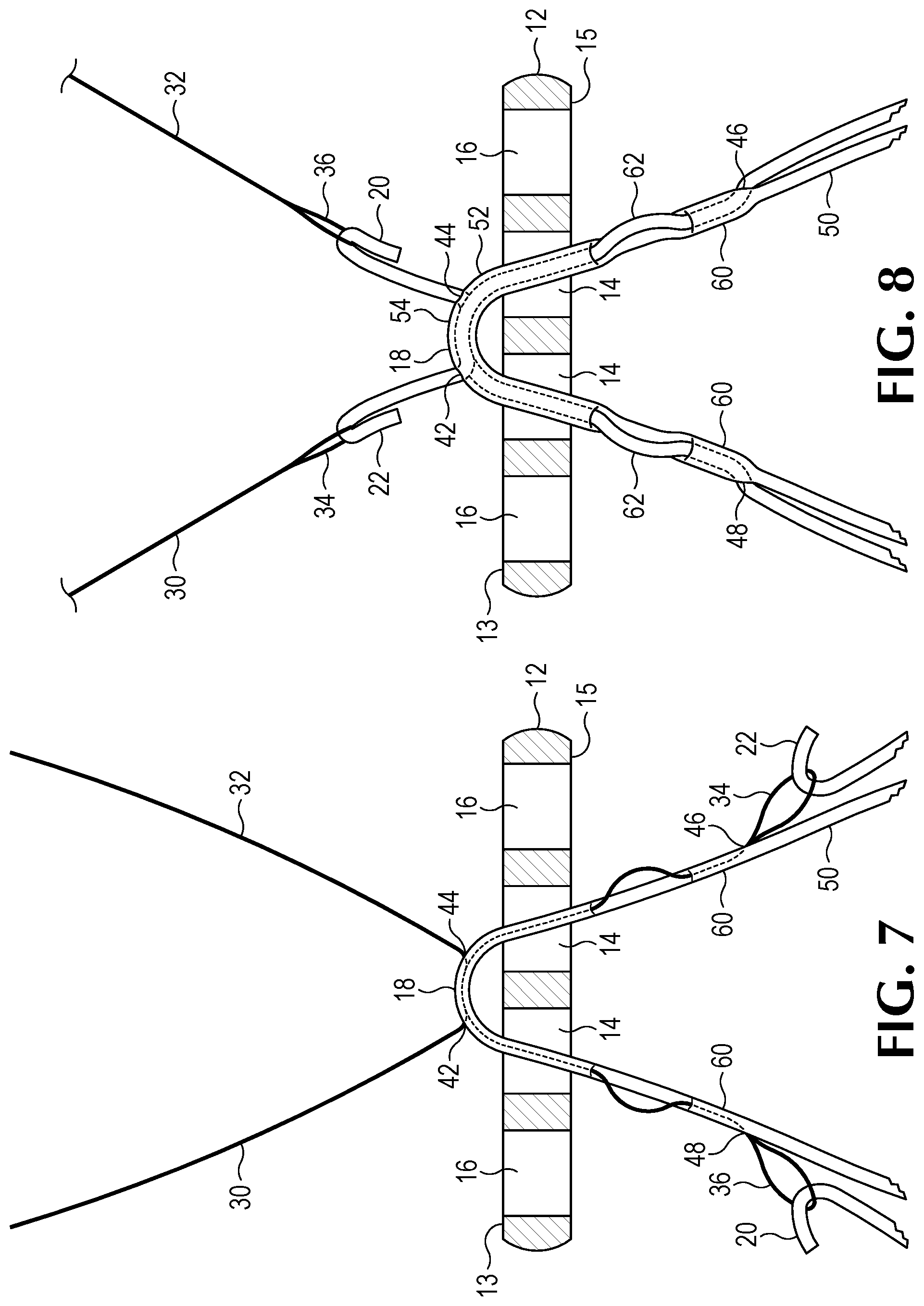 Patent US12508122 Figure 6 – Method of forming a suture-button-graft combination and facilitating construct