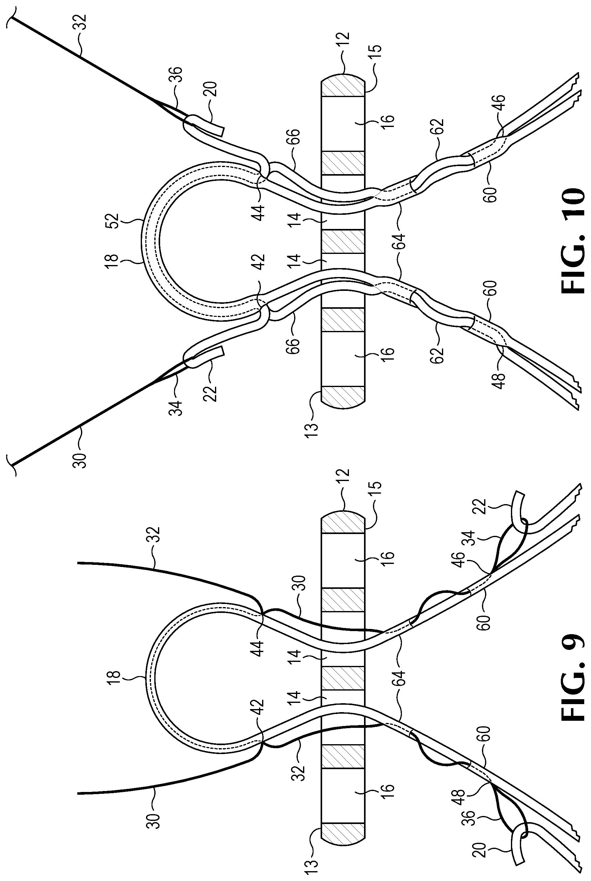 Patent US12508122 Figure 7 – Method of forming a suture-button-graft combination and facilitating construct