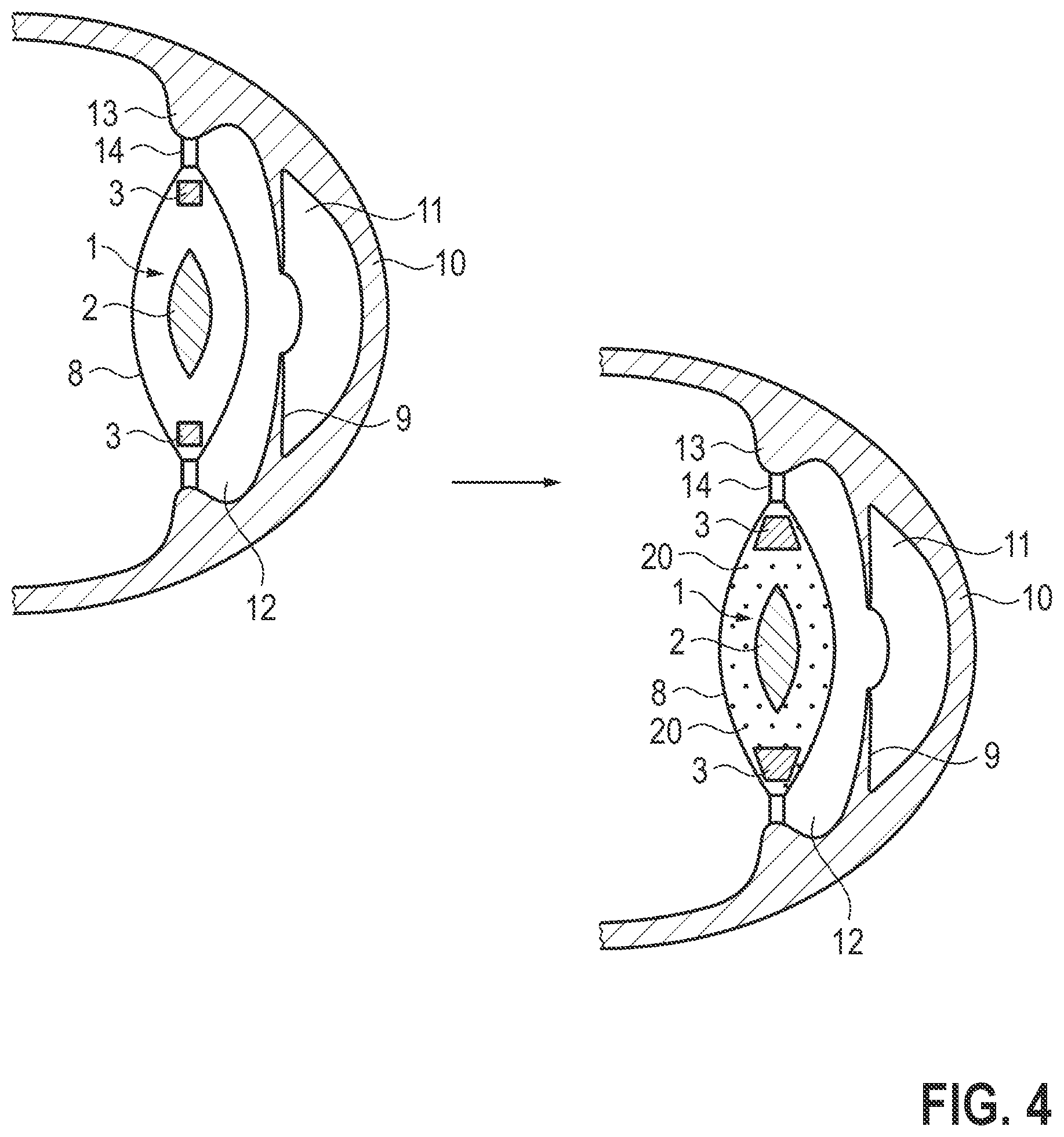 Patent US12508123 Figure 3 – Intraocular lens and treatment apparatus