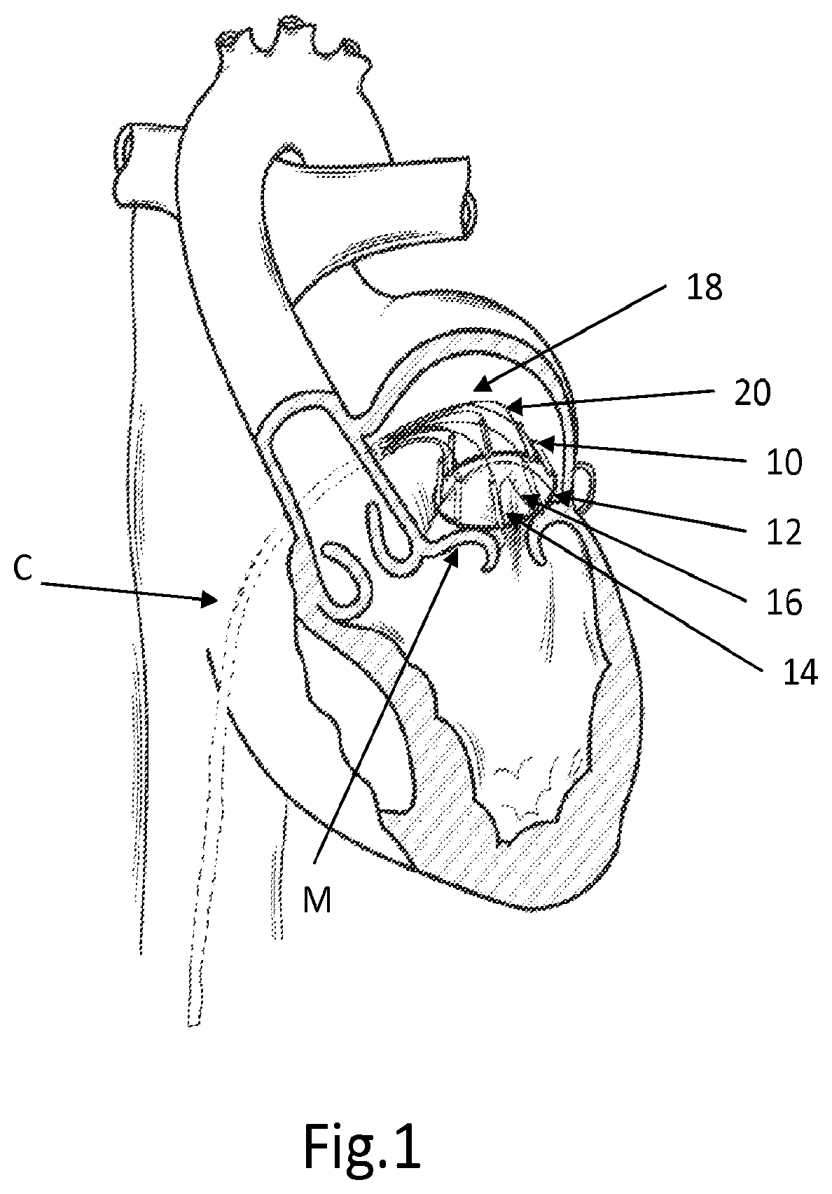 Patent US12508129 Figure 1 – Cardiac valve replacement