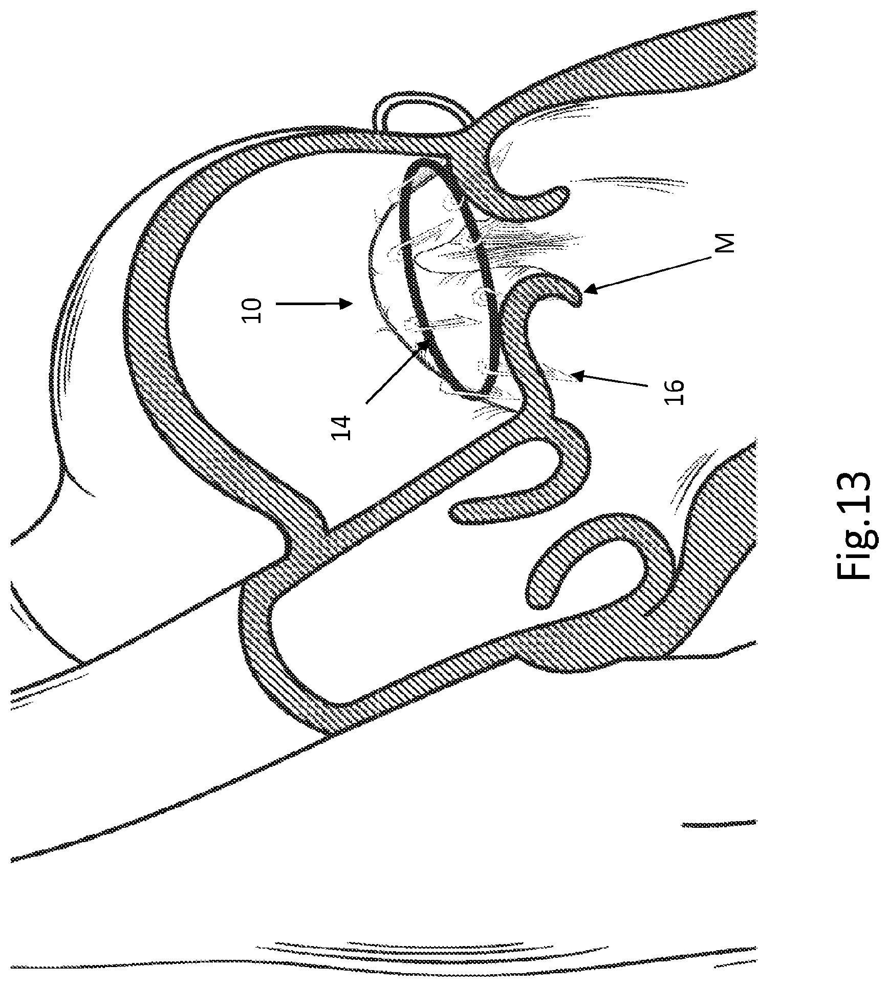 Patent US12508129 Figure 10 – Cardiac valve replacement