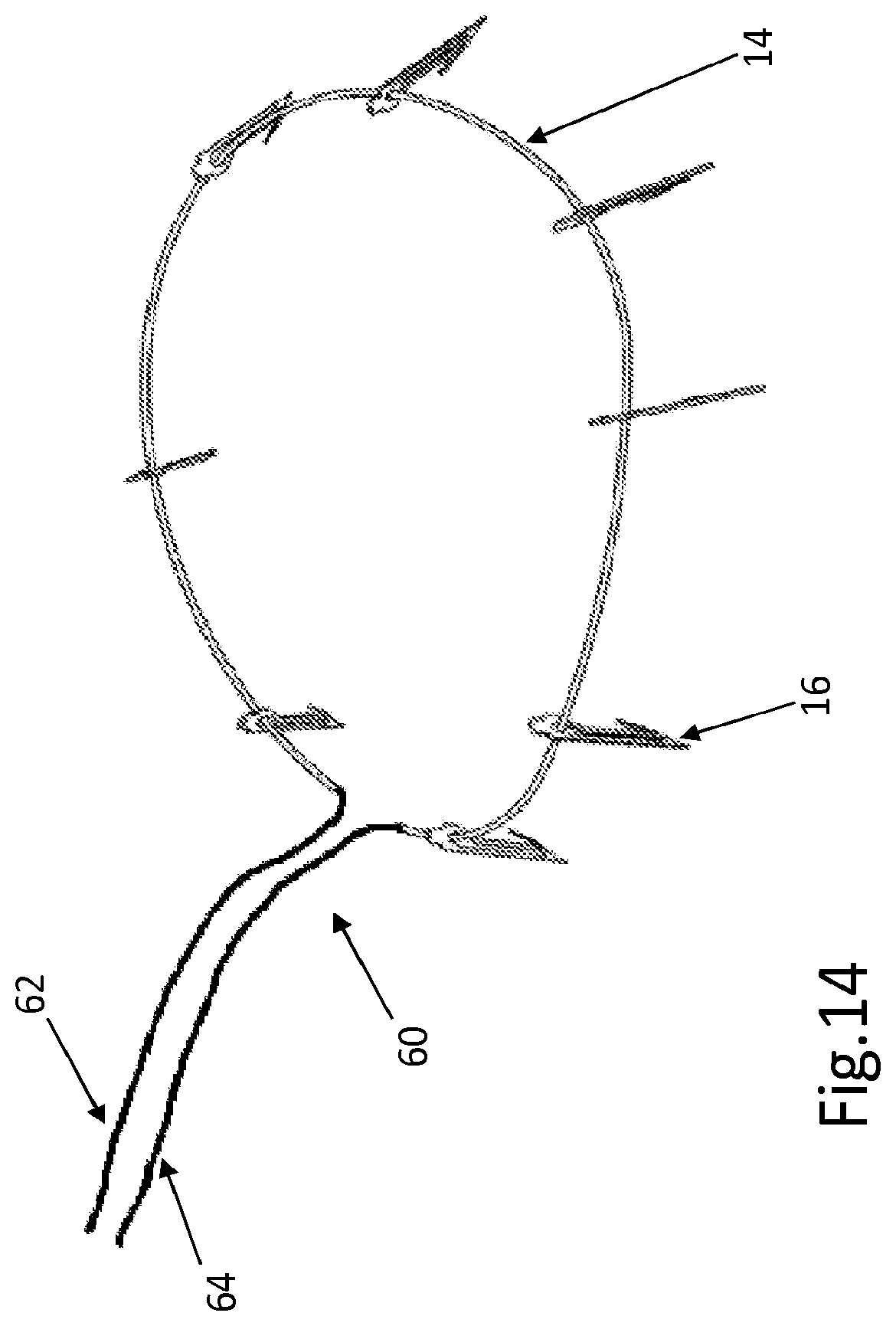 Patent US12508129 Figure 11 – Cardiac valve replacement