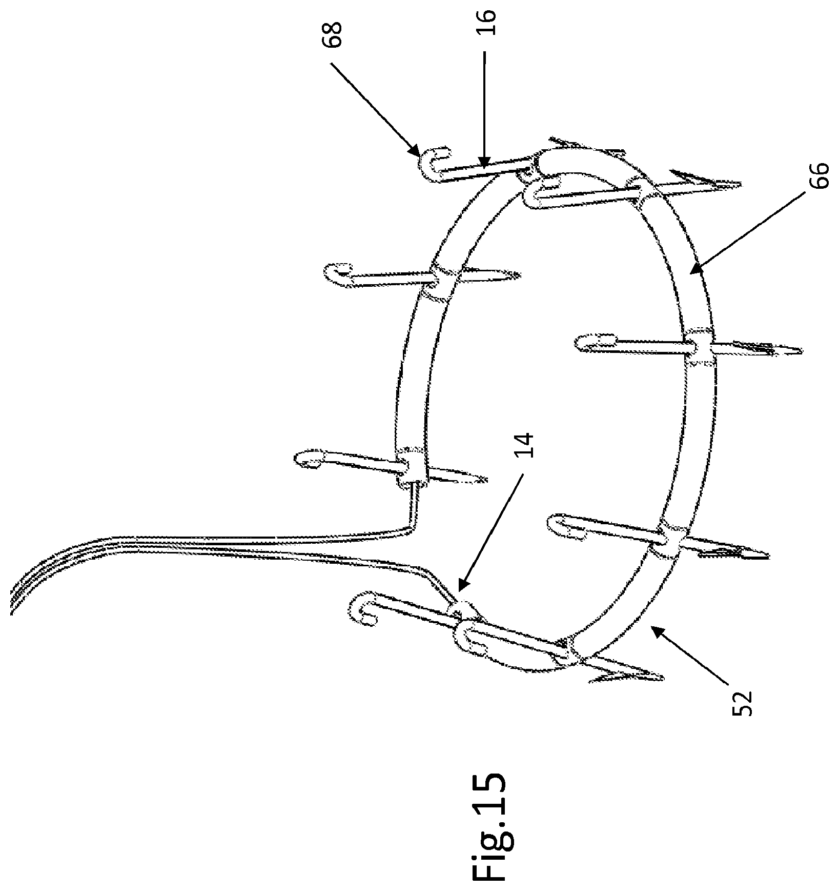 Patent US12508129 Figure 12 – Cardiac valve replacement