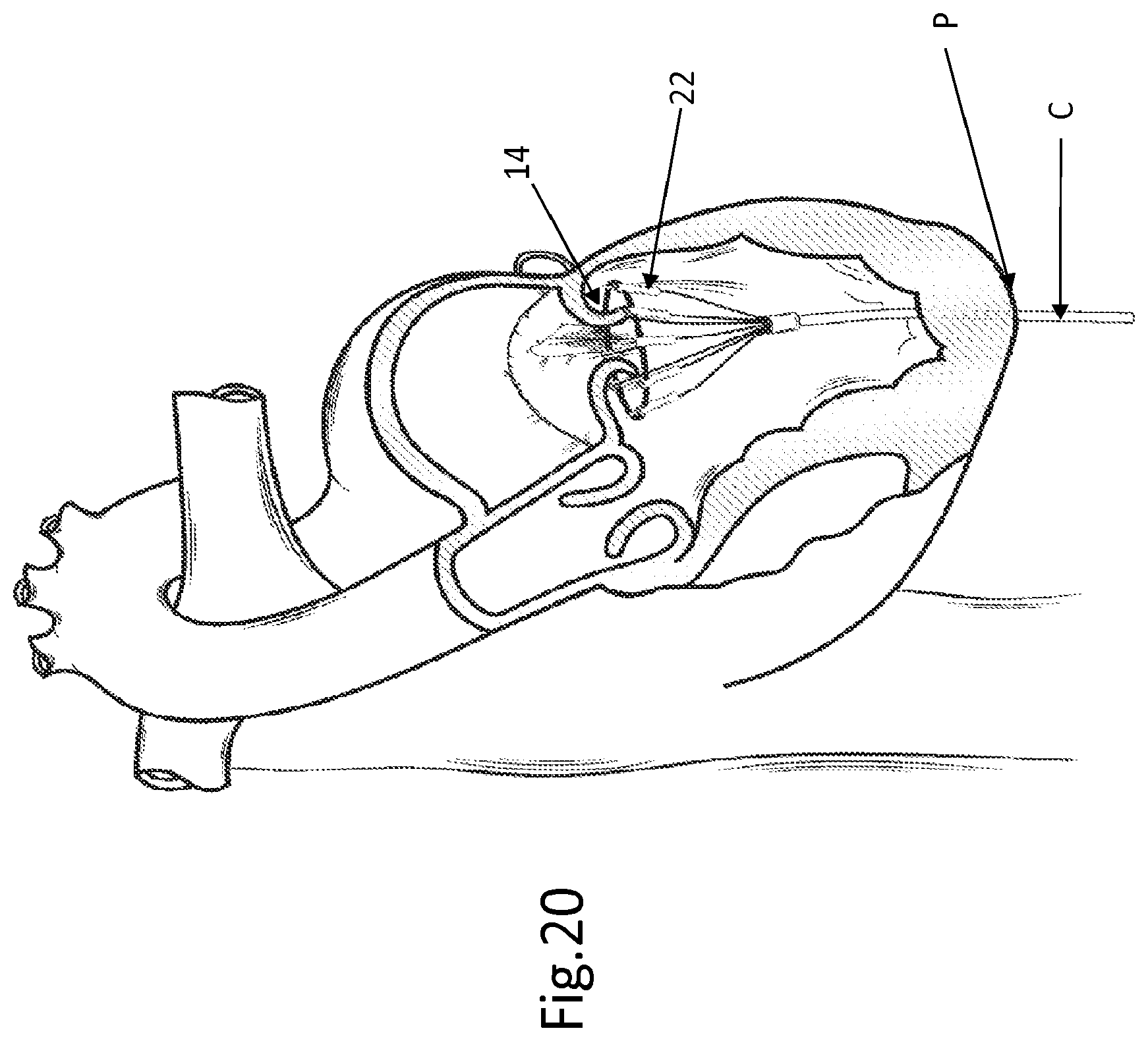 Patent US12508129 Figure 15 – Cardiac valve replacement