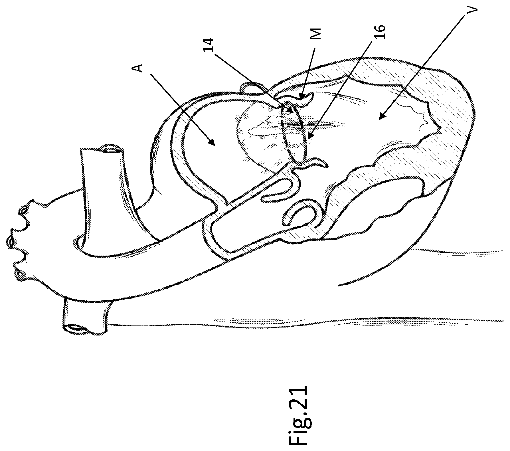 Patent US12508129 Figure 16 – Cardiac valve replacement