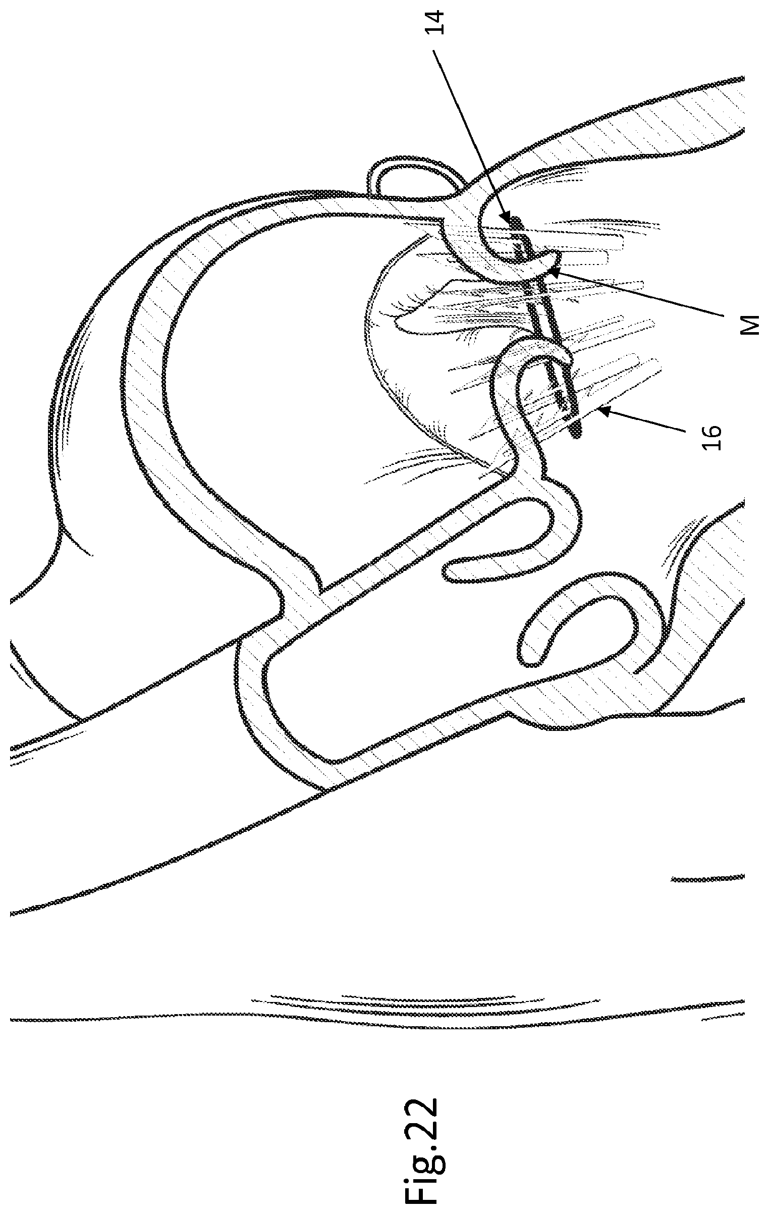 Patent US12508129 Figure 17 – Cardiac valve replacement