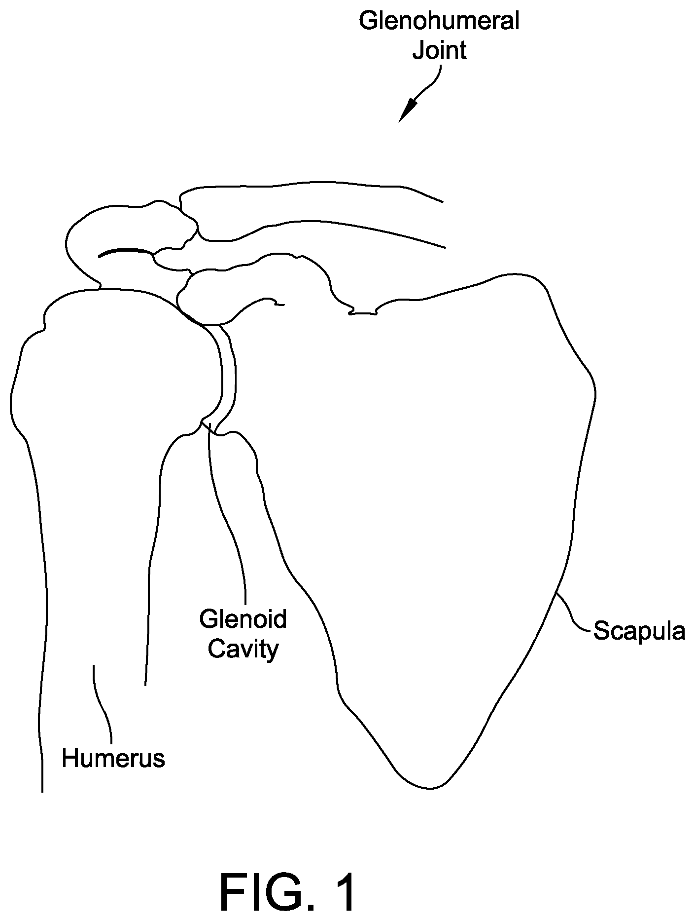 Patent US12508130 Figure 1 – Glenoid implant components and instruments therefor