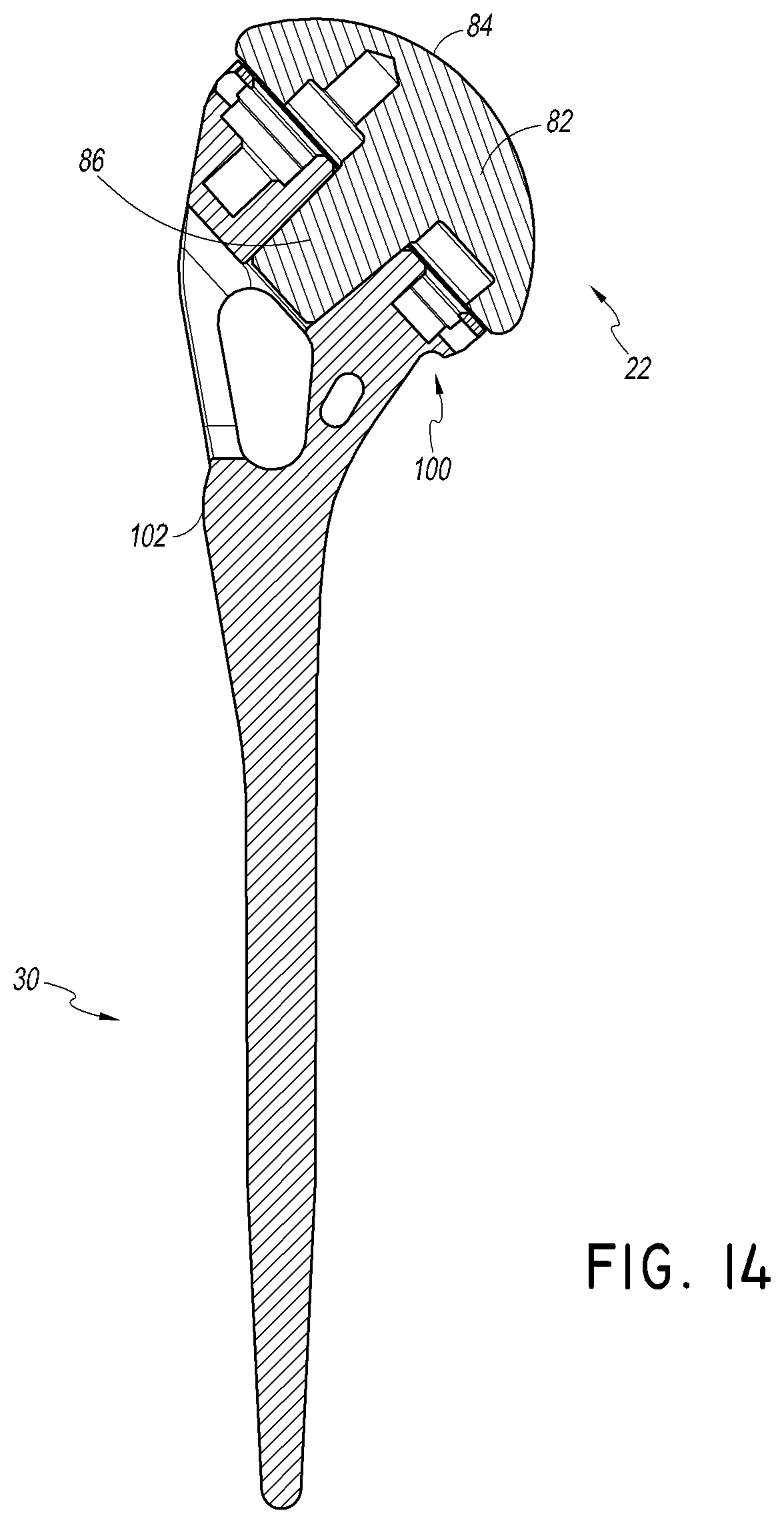 Patent US12508132 Figure 18 – Convertible stem/fracture stem