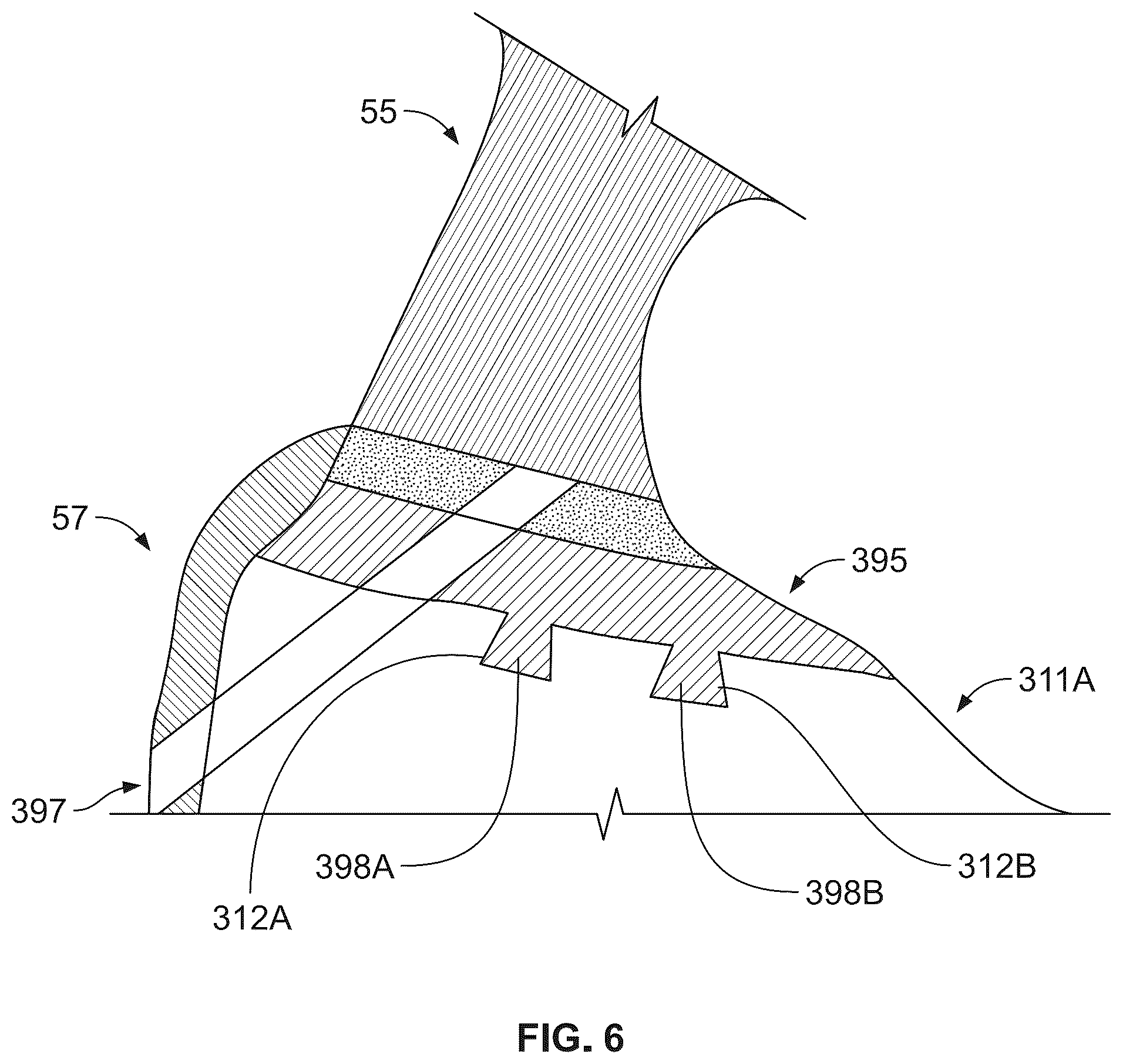 Patent US12508134 Figure 5 – Augmented, just-in-time, patient-specific implant manufacture
