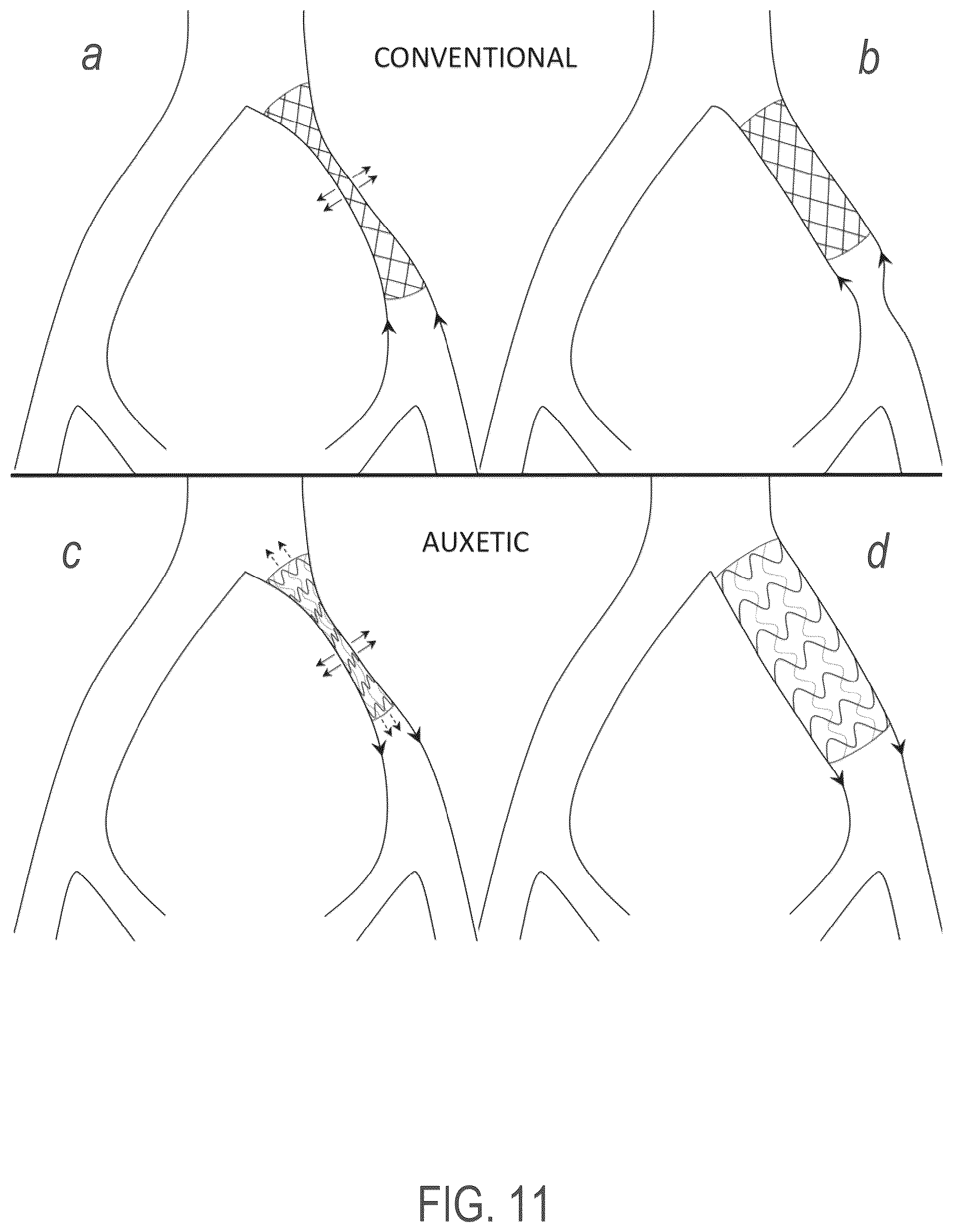 Patent US12508139 Figure 8 – Auxetic stents for managing venous stenosis